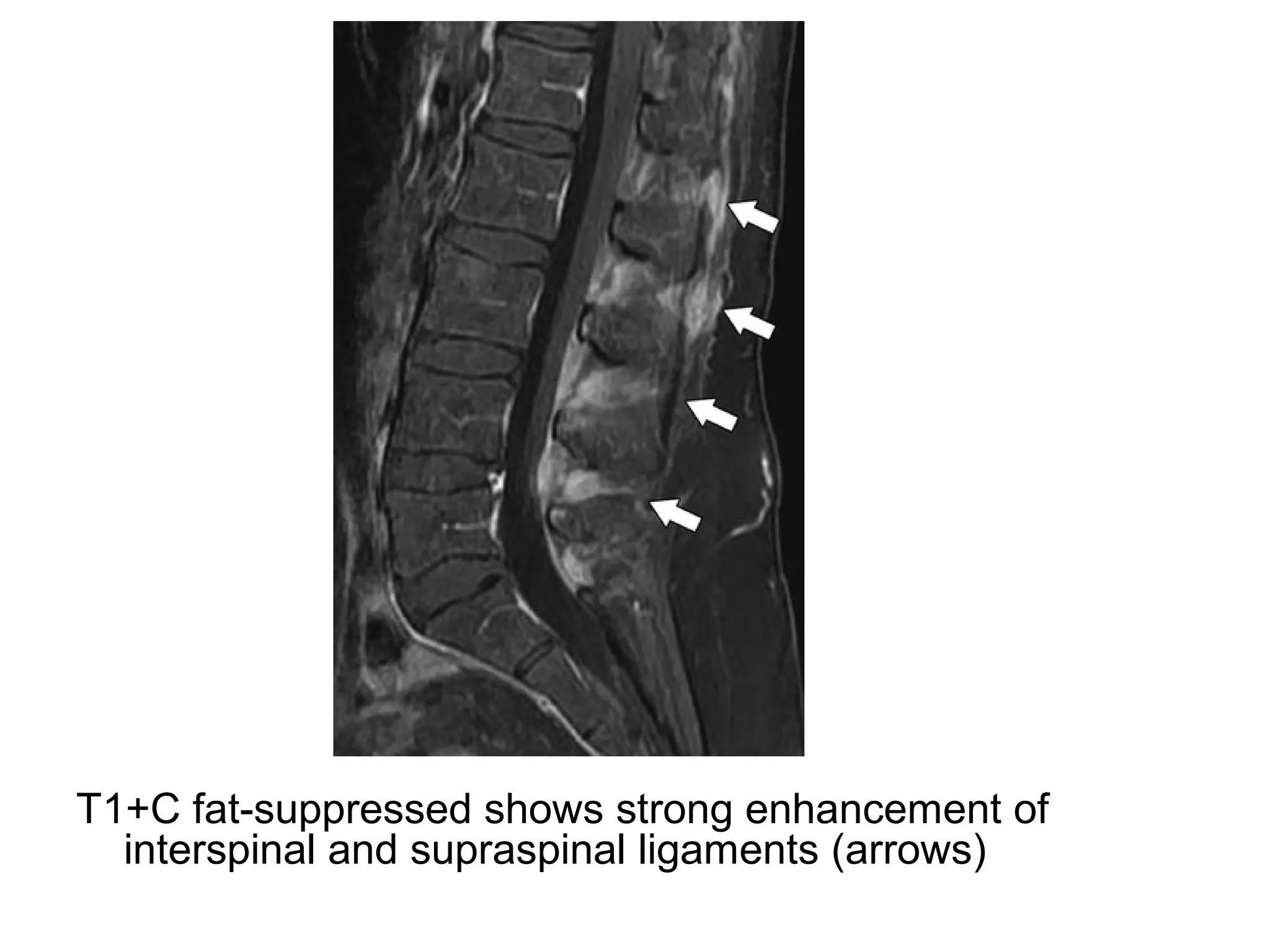 T1+C fat-suppressed shows strong enhancement of
interspinal and supraspinal ligaments (arrows)
 