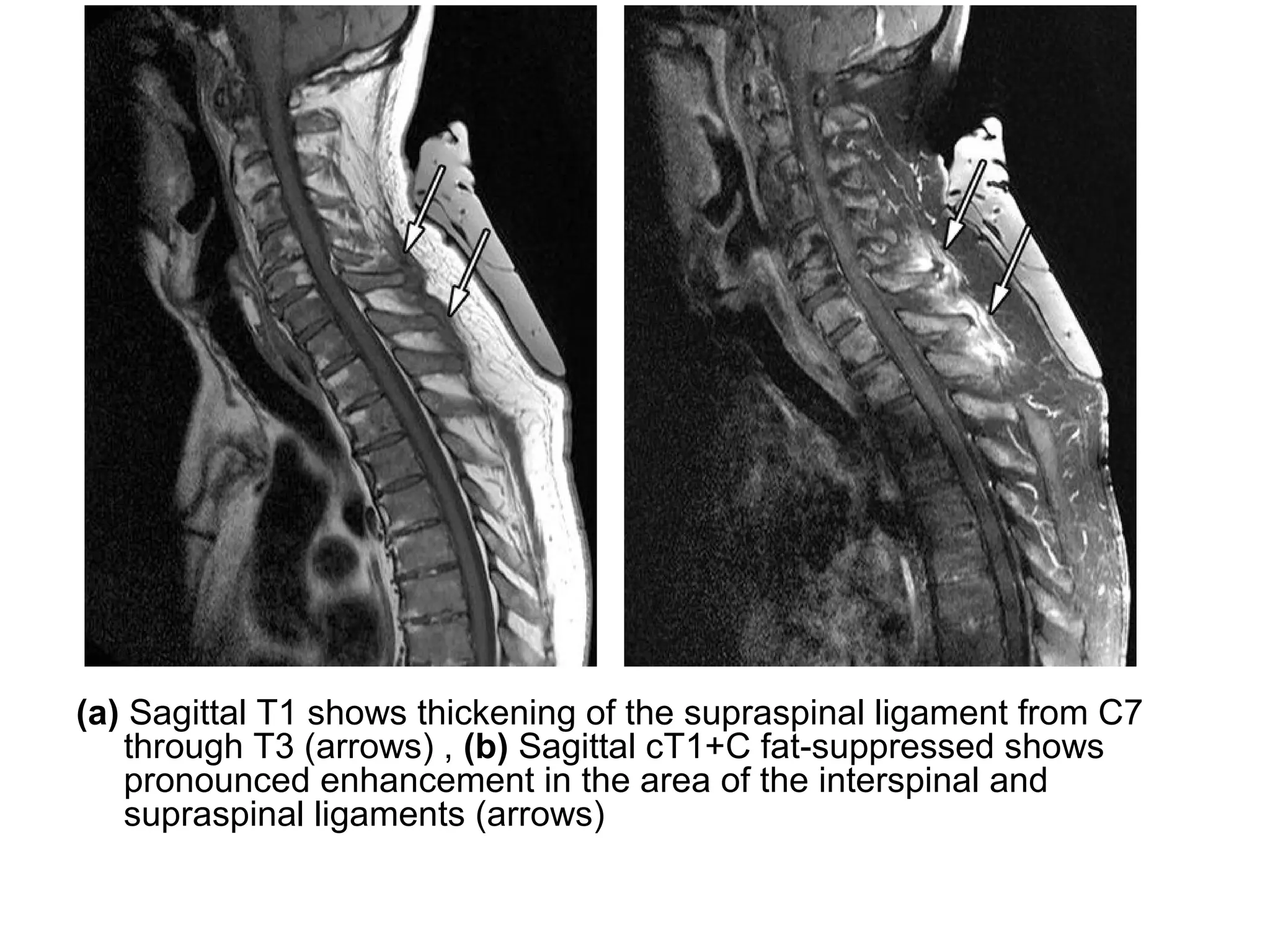 (a) Sagittal T1 shows thickening of the supraspinal ligament from C7
through T3 (arrows) , (b) Sagittal cT1+C fat-suppressed shows
pronounced enhancement in the area of the interspinal and
supraspinal ligaments (arrows)
 