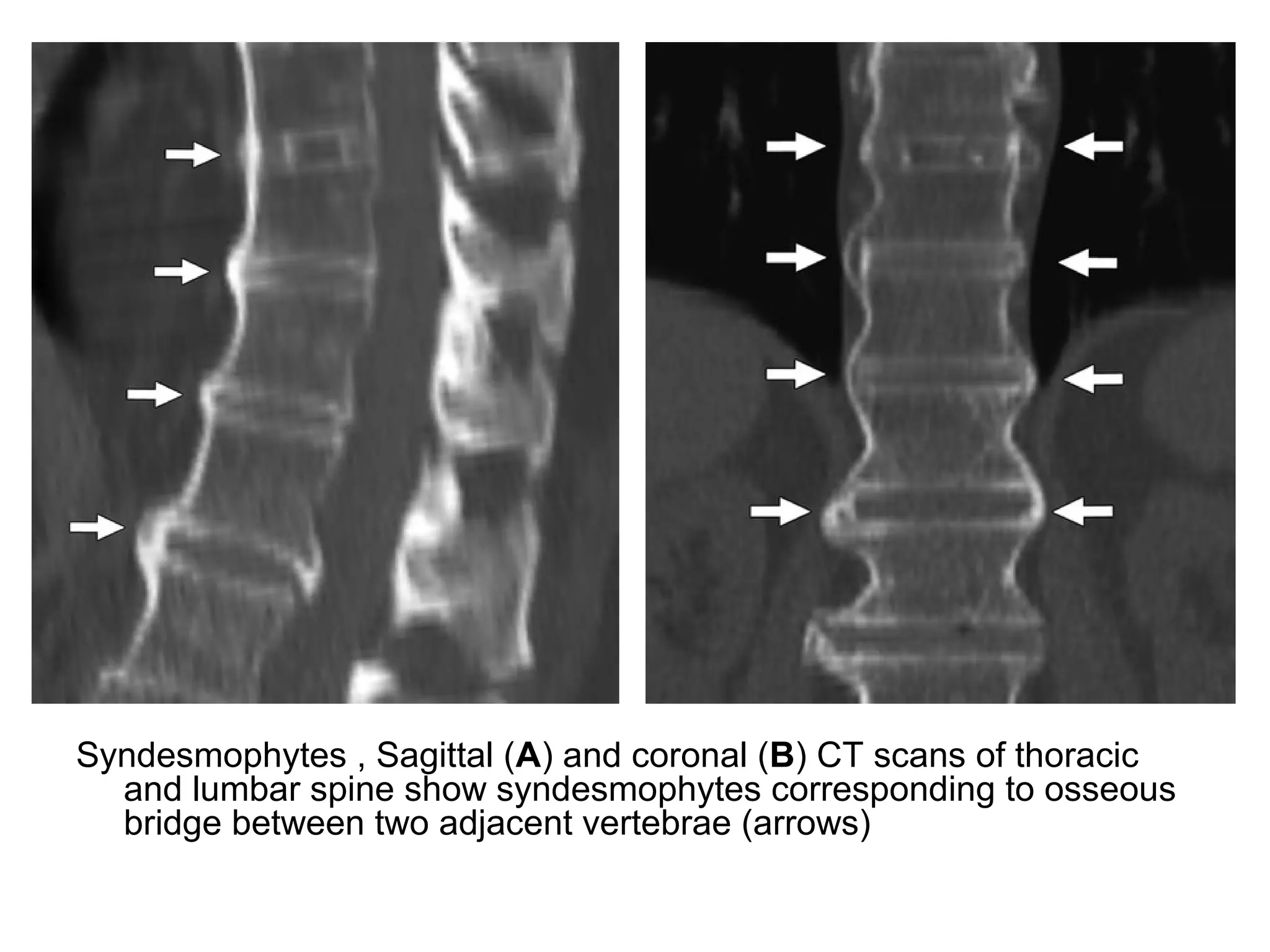 Syndesmophytes , Sagittal (A) and coronal (B) CT scans of thoracic
and lumbar spine show syndesmophytes corresponding to osseous
bridge between two adjacent vertebrae (arrows)
 