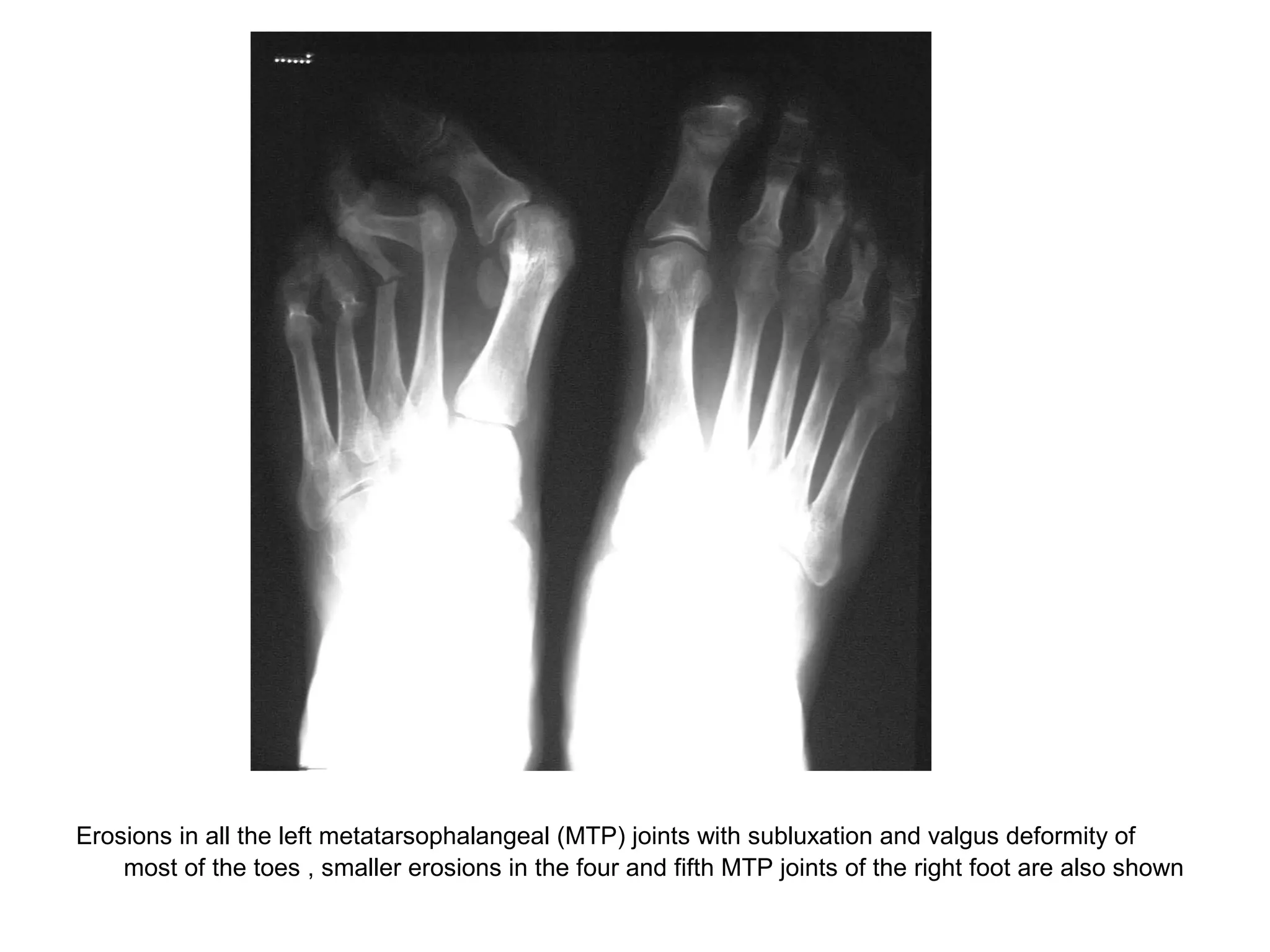Erosions in all the left metatarsophalangeal (MTP) joints with subluxation and valgus deformity of
most of the toes , smaller erosions in the four and fifth MTP joints of the right foot are also shown
 