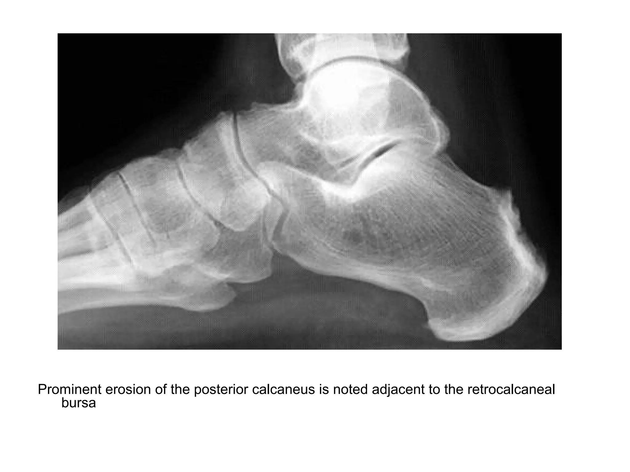 Prominent erosion of the posterior calcaneus is noted adjacent to the retrocalcaneal
bursa
 