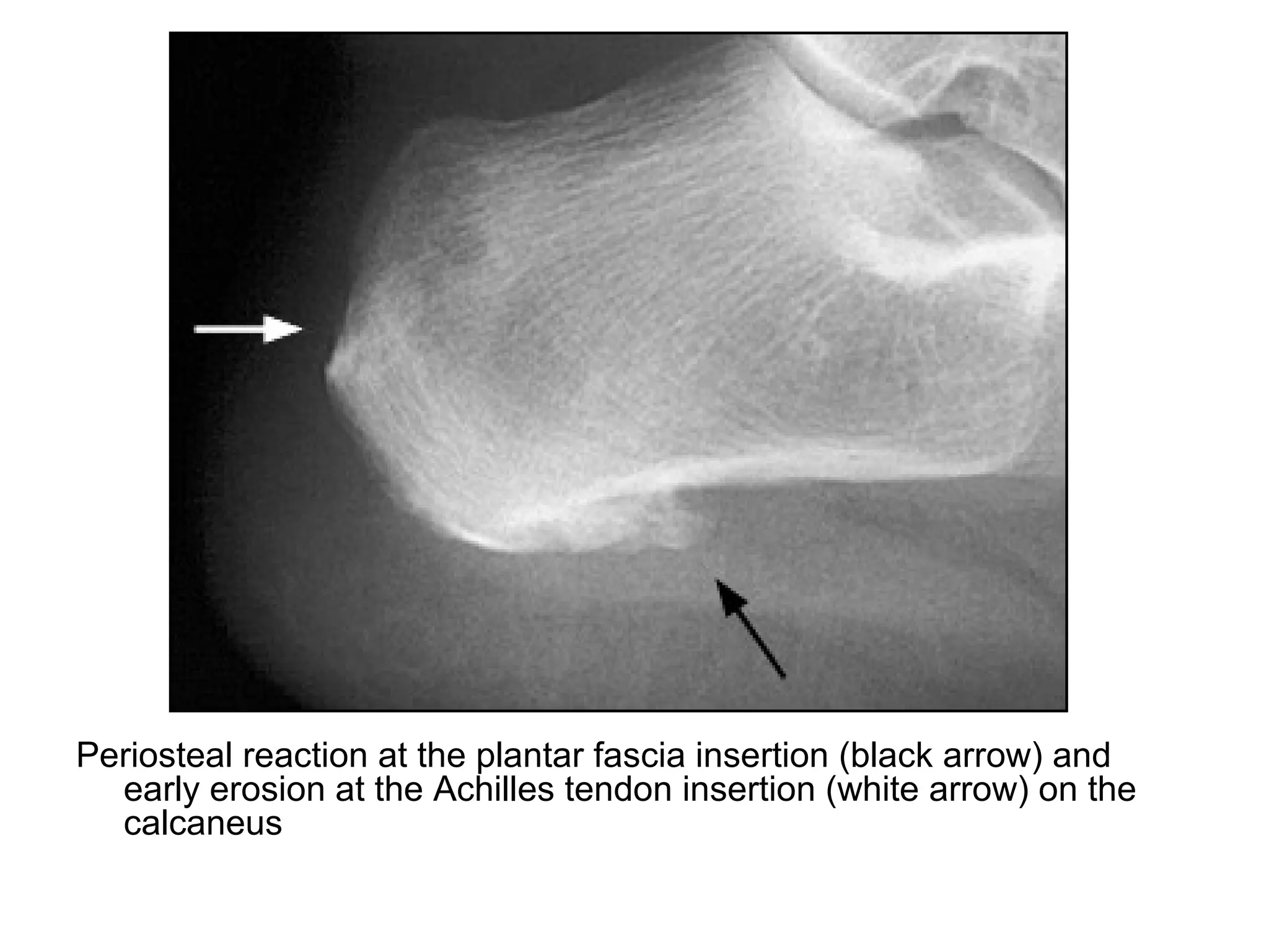 Periosteal reaction at the plantar fascia insertion (black arrow) and
early erosion at the Achilles tendon insertion (white arrow) on the
calcaneus
 