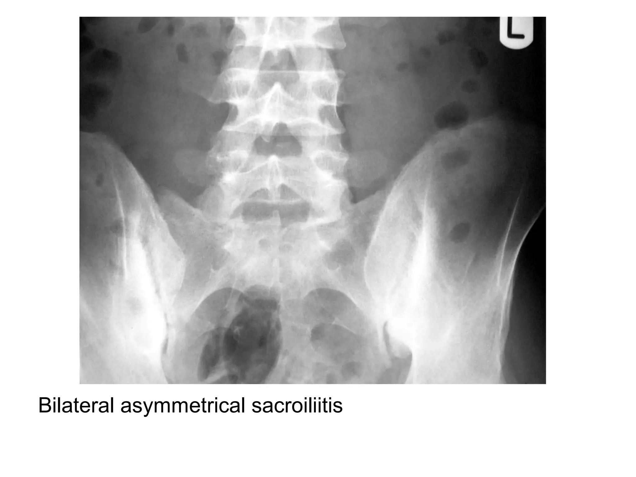 Bilateral asymmetrical sacroiliitis
 