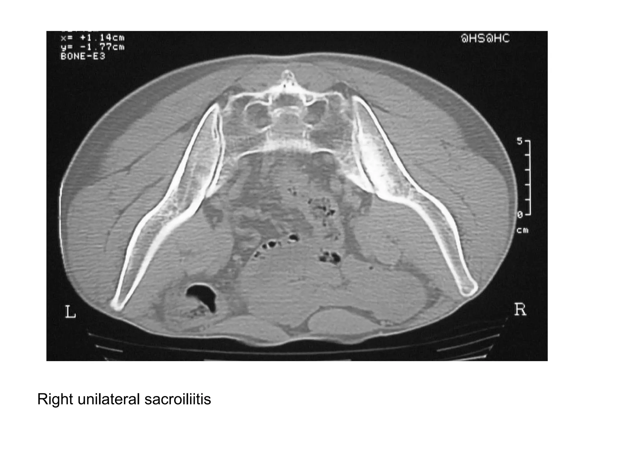 Right unilateral sacroiliitis
 