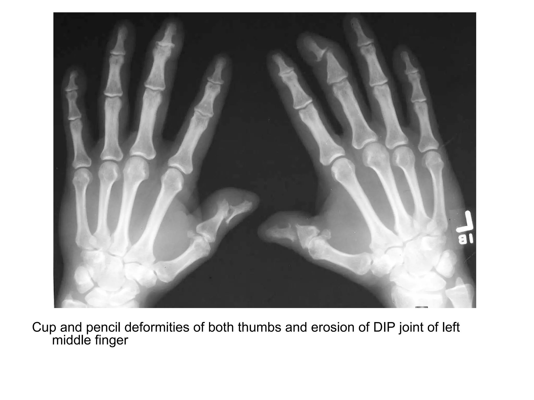 Cup and pencil deformities of both thumbs and erosion of DIP joint of left
middle finger
 
