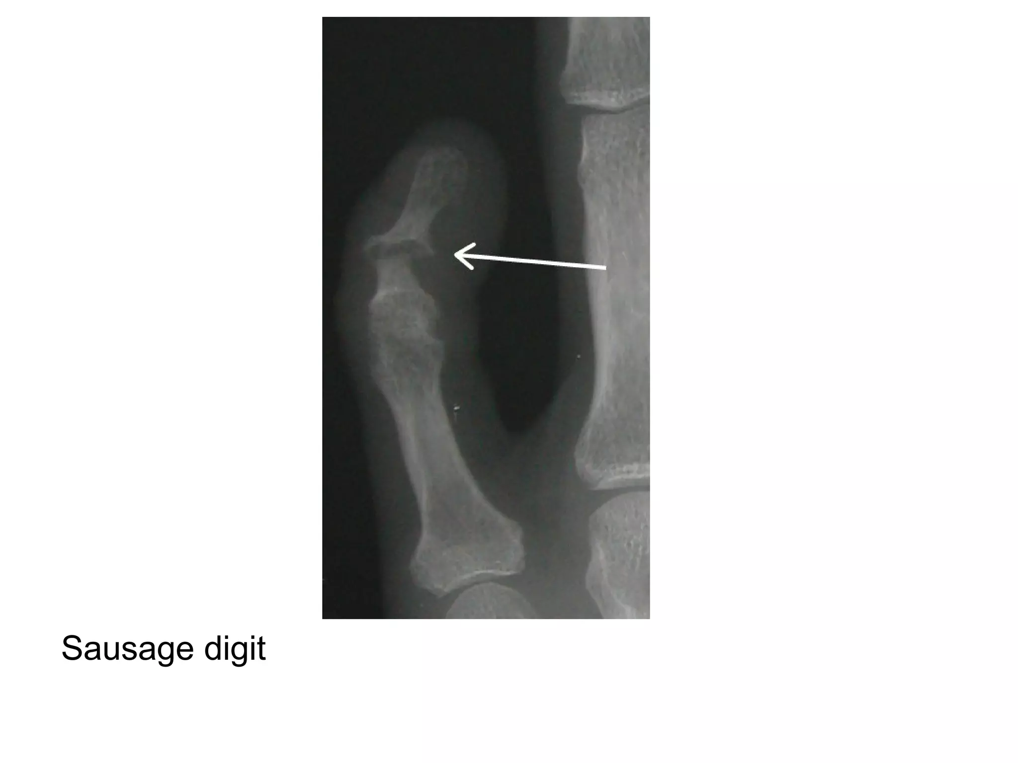 Sausage digit
 
