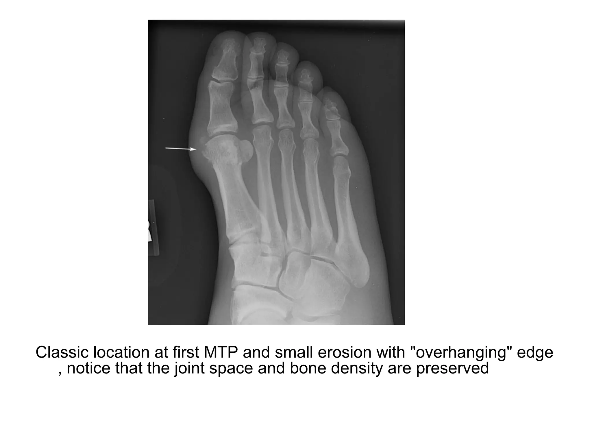 Classic location at first MTP and small erosion with "overhanging" edge
, notice that the joint space and bone density are preserved
 