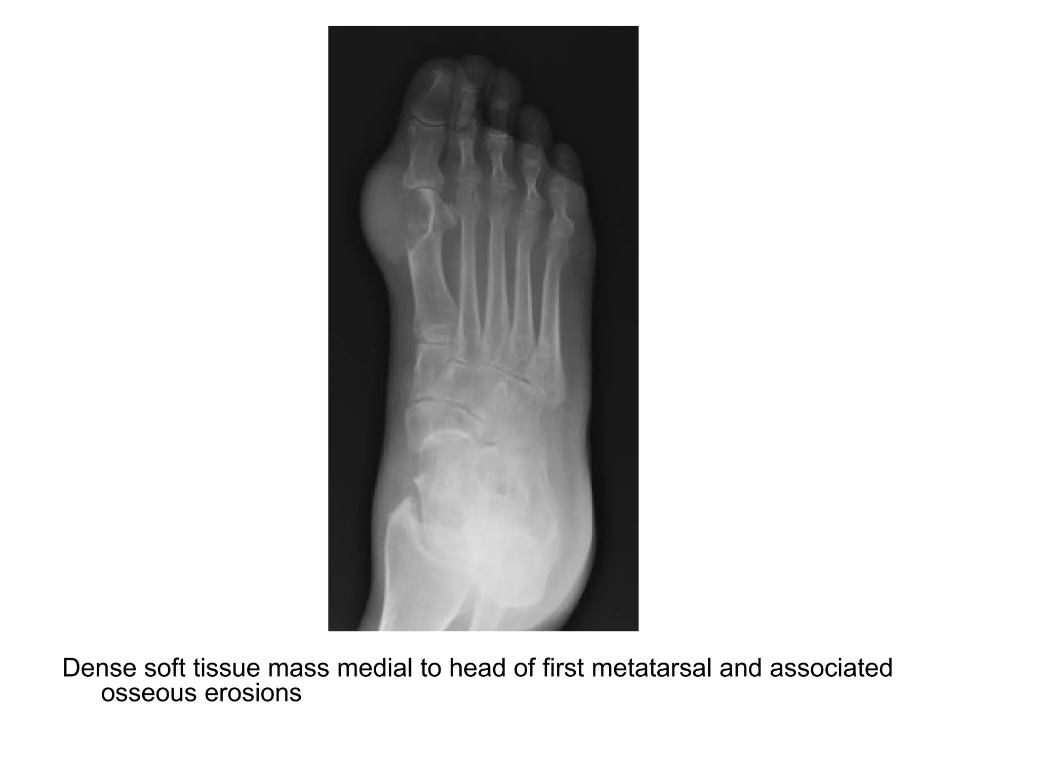 Dense soft tissue mass medial to head of first metatarsal and associated
osseous erosions
 