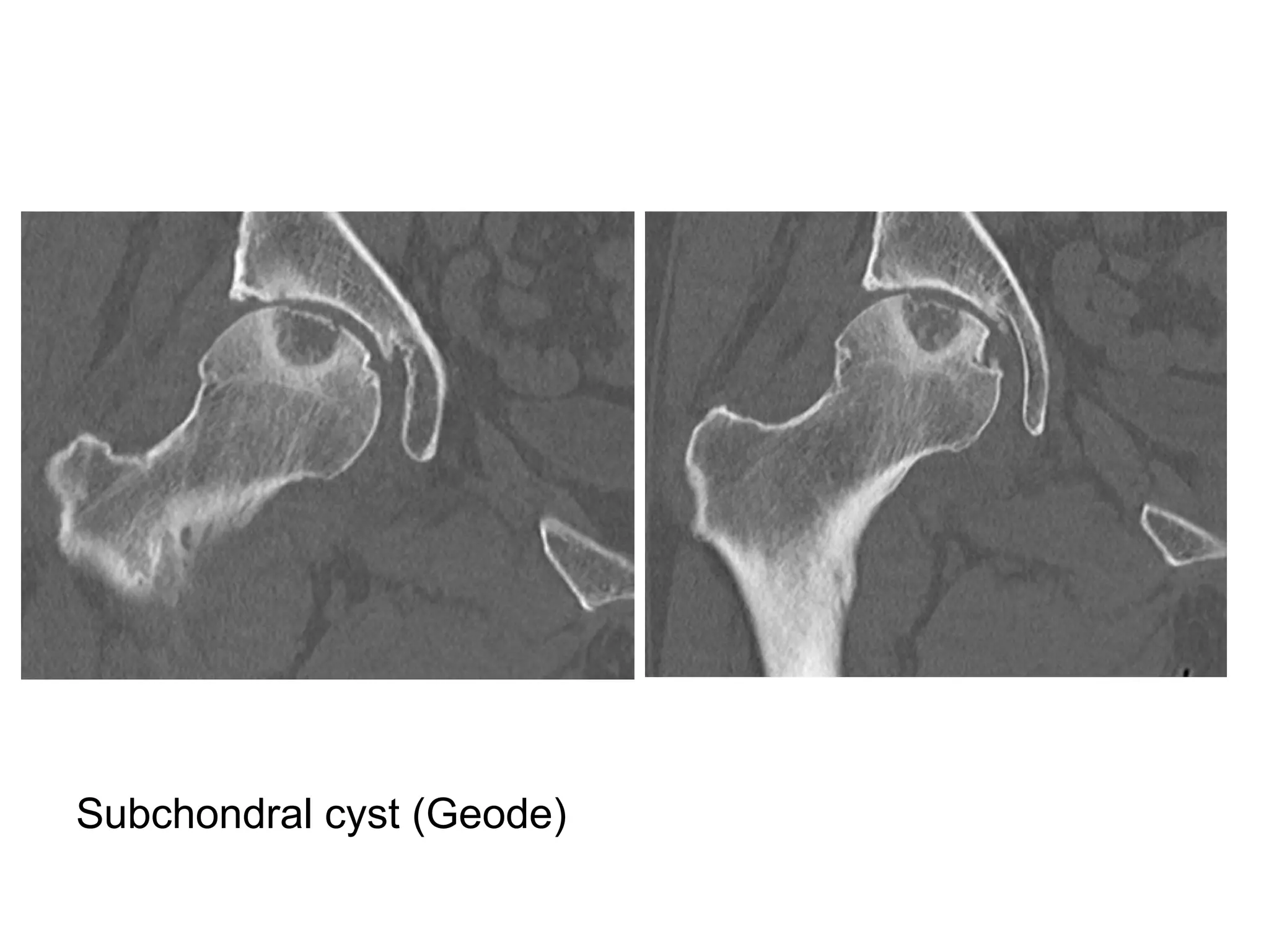 Subchondral cyst (Geode)
 
