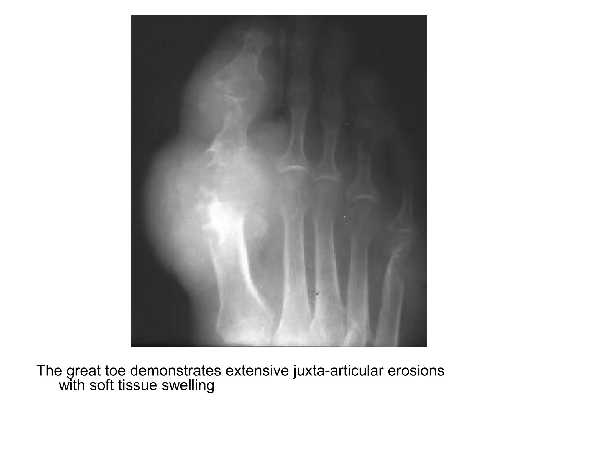 The great toe demonstrates extensive juxta-articular erosions
with soft tissue swelling
 