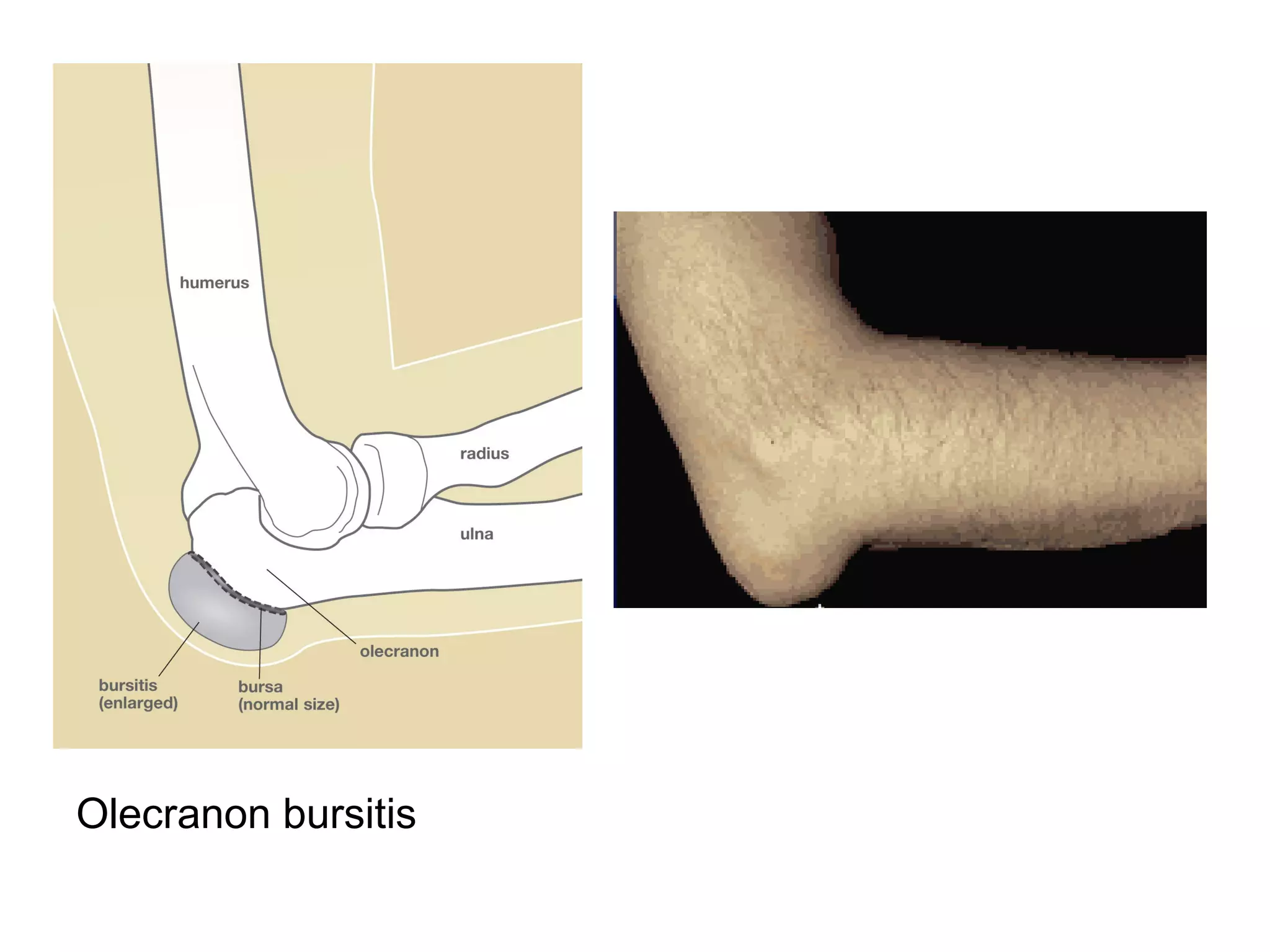 Olecranon bursitis
 