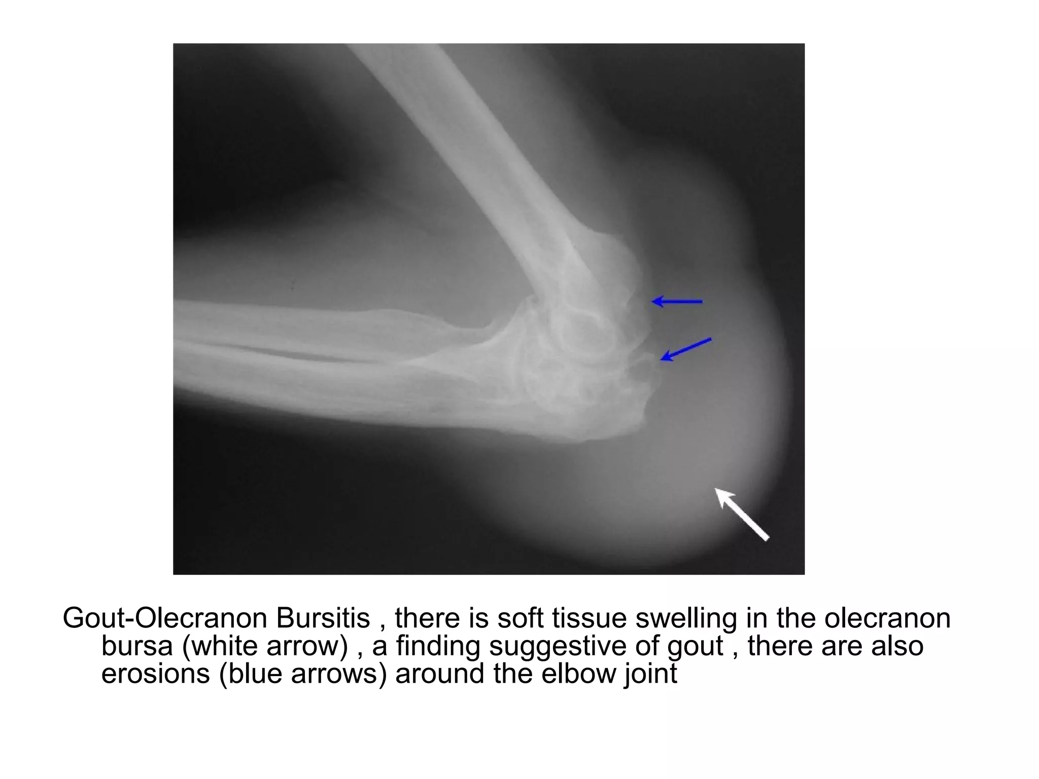 Gout-Olecranon Bursitis , there is soft tissue swelling in the olecranon
bursa (white arrow) , a finding suggestive of gout , there are also
erosions (blue arrows) around the elbow joint
 
