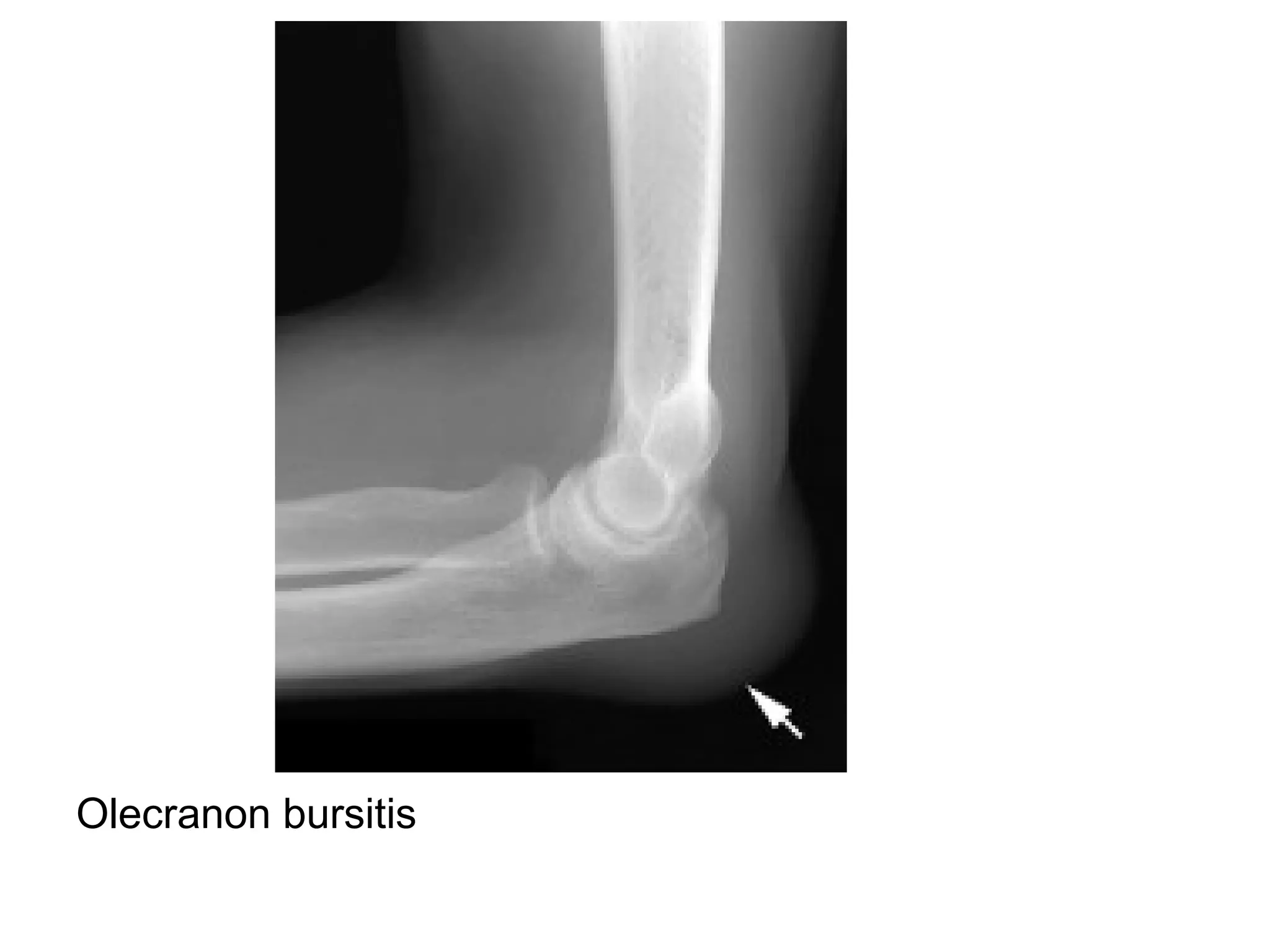 Olecranon bursitis
 