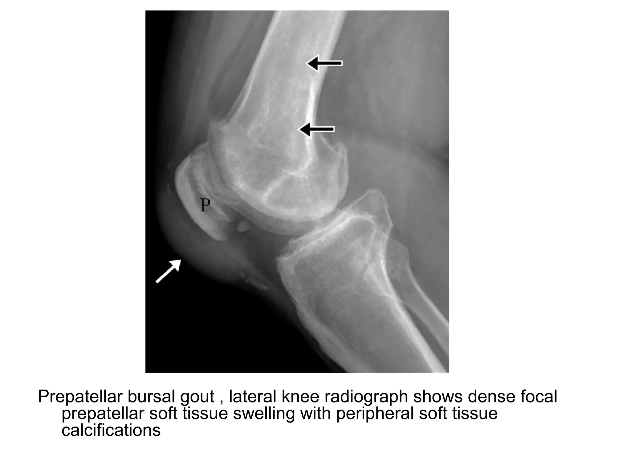 Prepatellar bursal gout , lateral knee radiograph shows dense focal
prepatellar soft tissue swelling with peripheral soft tissue
calcifications
 