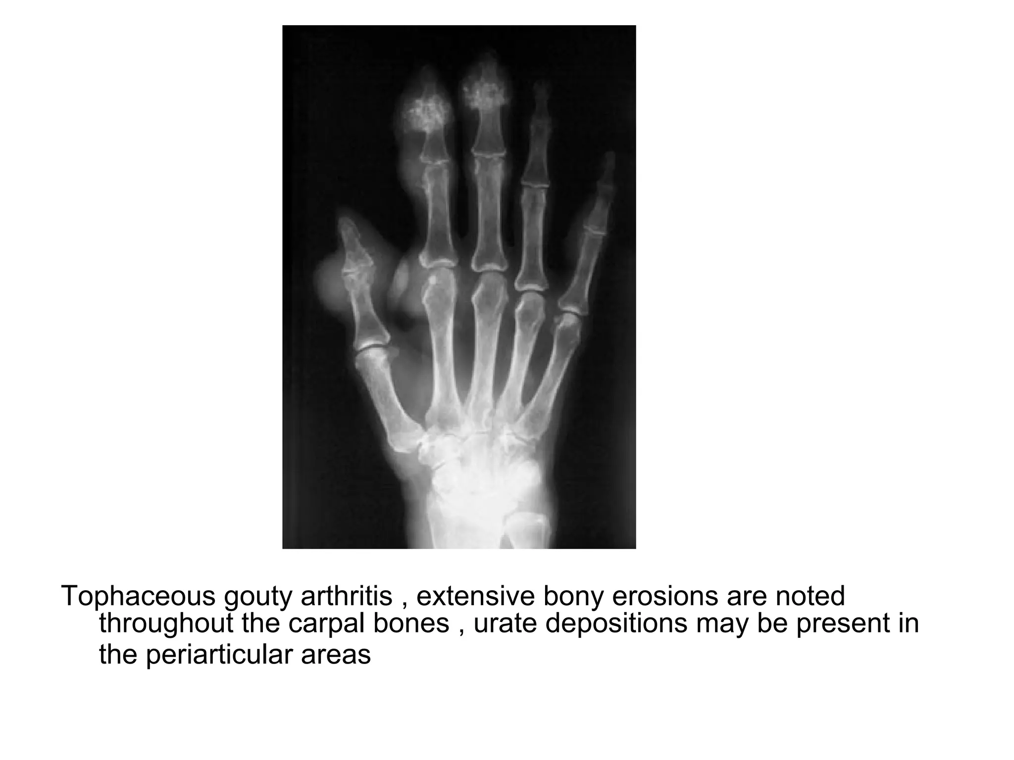 Tophaceous gouty arthritis , extensive bony erosions are noted
throughout the carpal bones , urate depositions may be present in
the periarticular areas
 