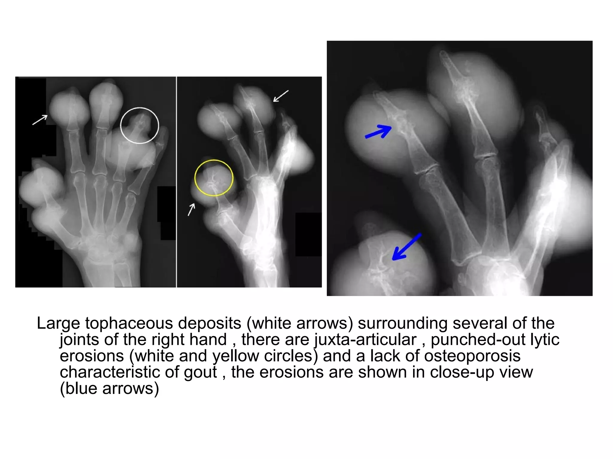 Large tophaceous deposits (white arrows) surrounding several of the
joints of the right hand , there are juxta-articular , punched-out lytic
erosions (white and yellow circles) and a lack of osteoporosis
characteristic of gout , the erosions are shown in close-up view
(blue arrows)
 