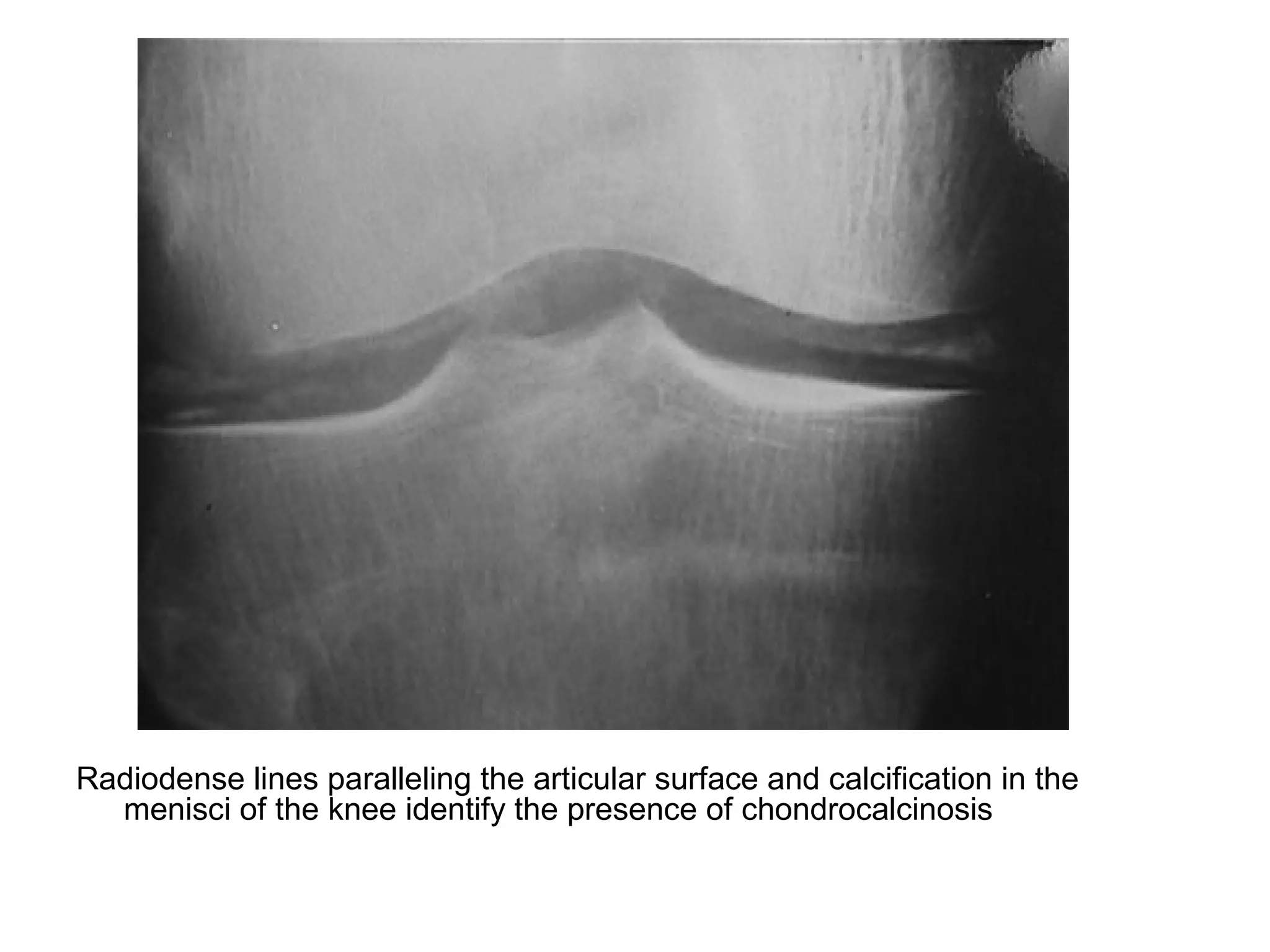 Radiodense lines paralleling the articular surface and calcification in the
menisci of the knee identify the presence of chondrocalcinosis
 
