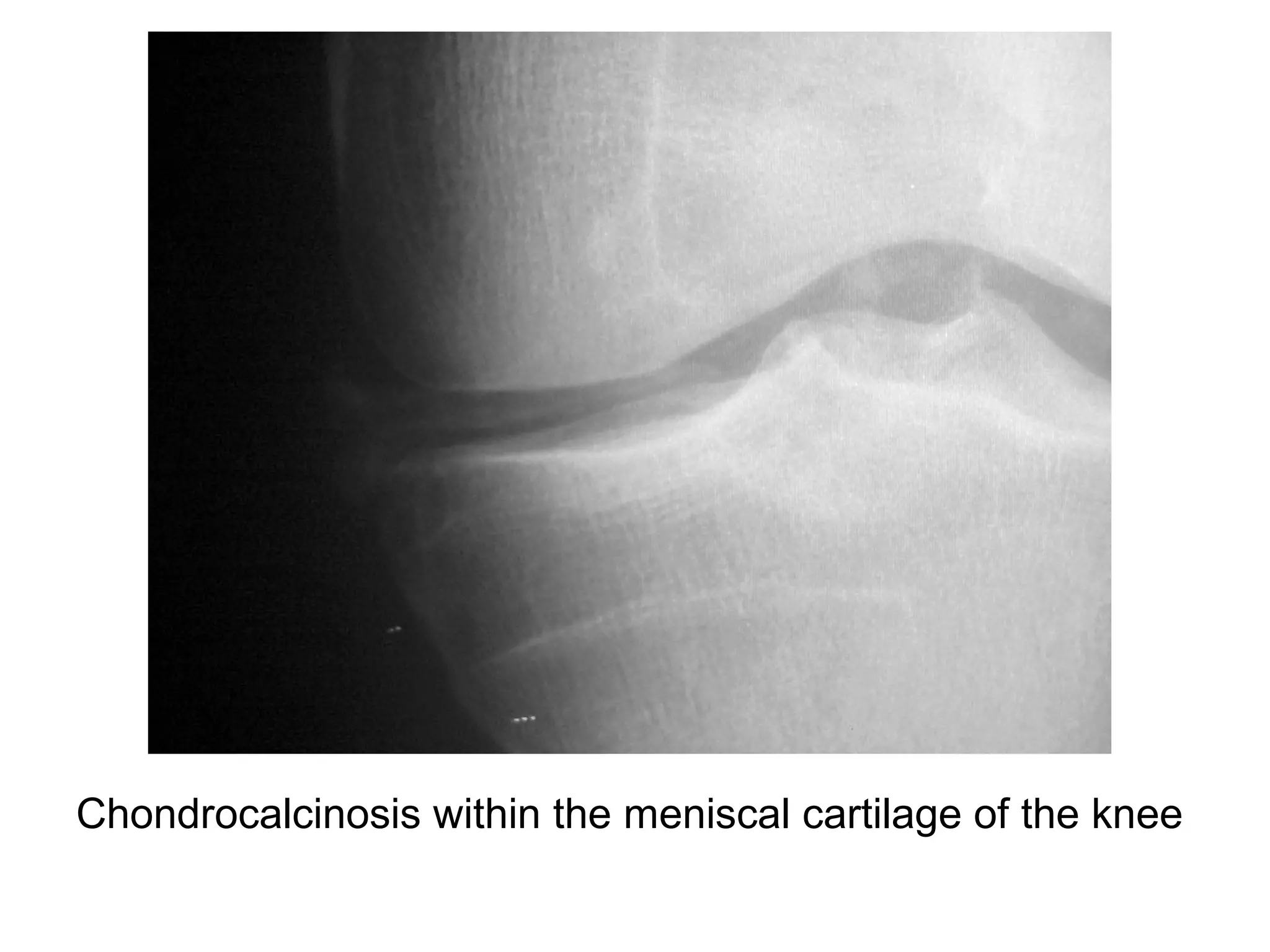 Chondrocalcinosis within the meniscal cartilage of the knee
 