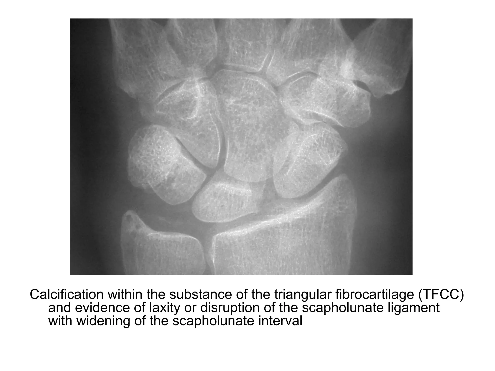Calcification within the substance of the triangular fibrocartilage (TFCC)
and evidence of laxity or disruption of the scapholunate ligament
with widening of the scapholunate interval
 