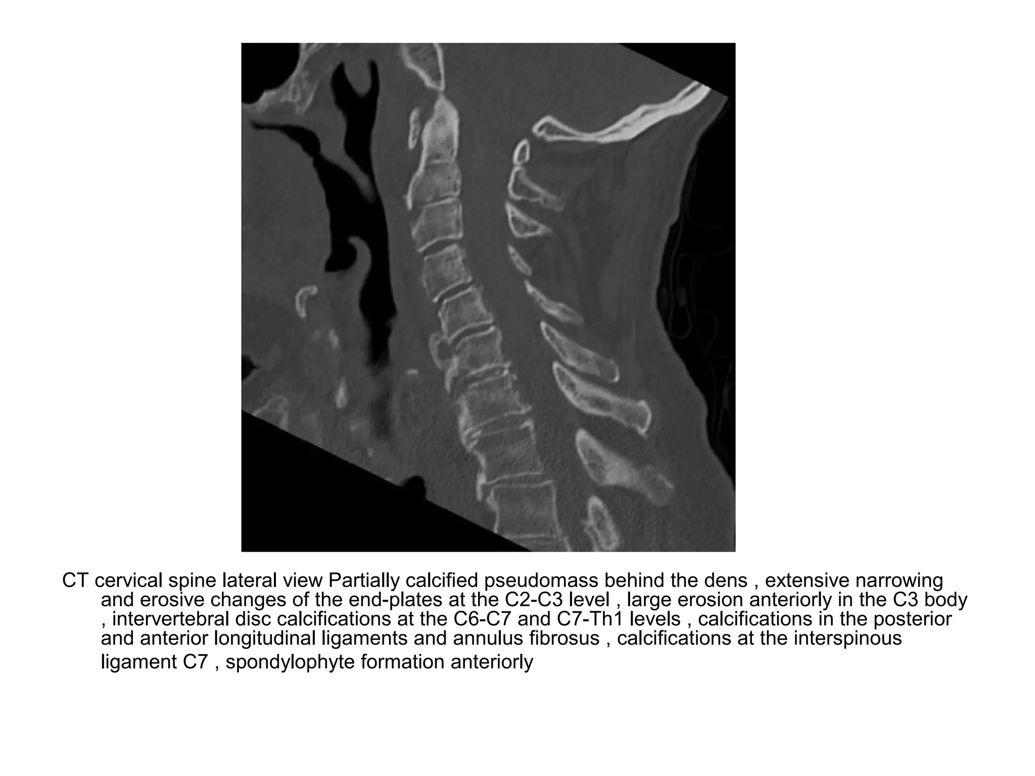 CT cervical spine lateral view Partially calcified pseudomass behind the dens , extensive narrowing
and erosive changes of the end-plates at the C2-C3 level , large erosion anteriorly in the C3 body
, intervertebral disc calcifications at the C6-C7 and C7-Th1 levels , calcifications in the posterior
and anterior longitudinal ligaments and annulus fibrosus , calcifications at the interspinous
ligament C7 , spondylophyte formation anteriorly
 