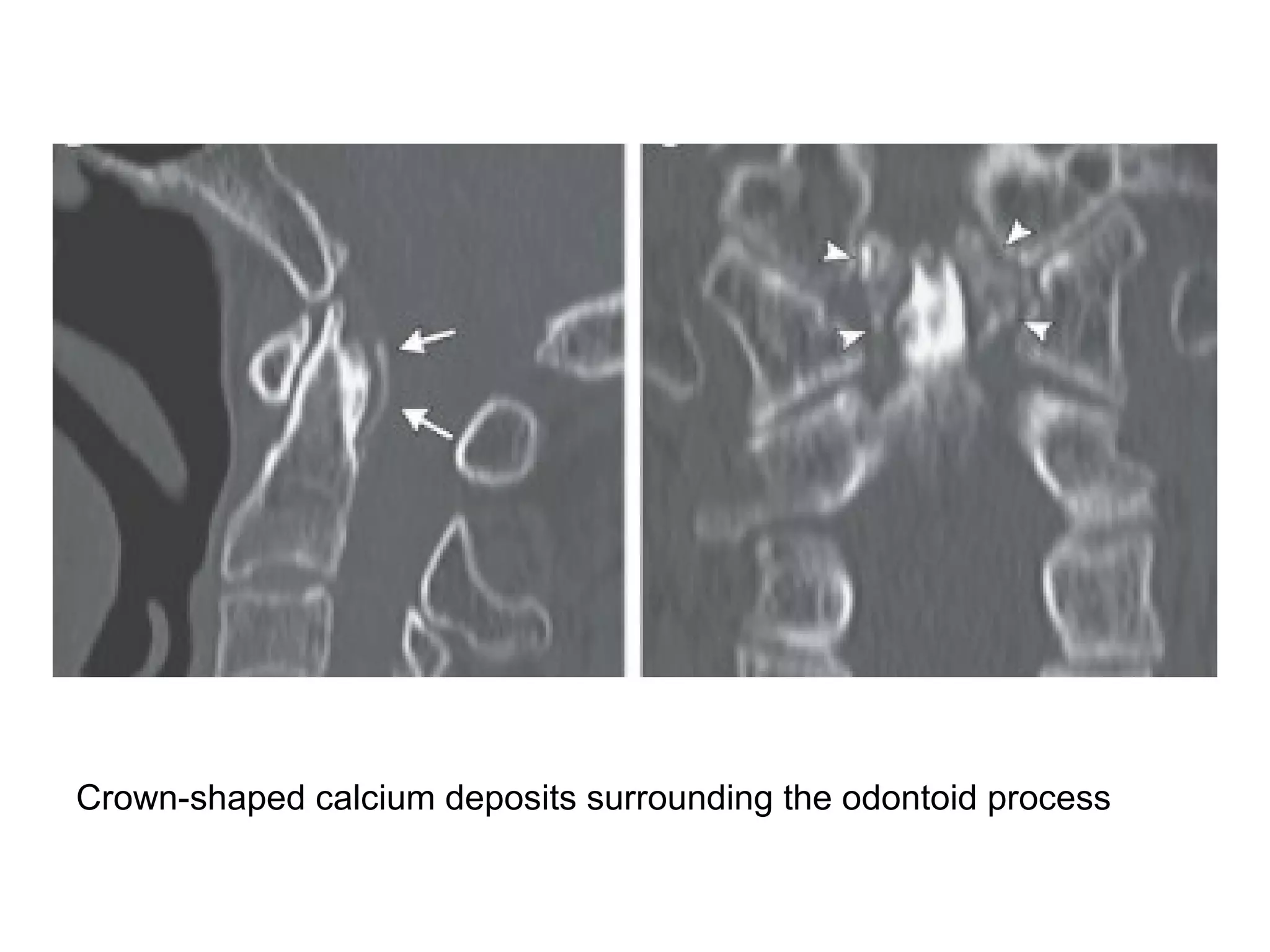 Crown-shaped calcium deposits surrounding the odontoid process
 