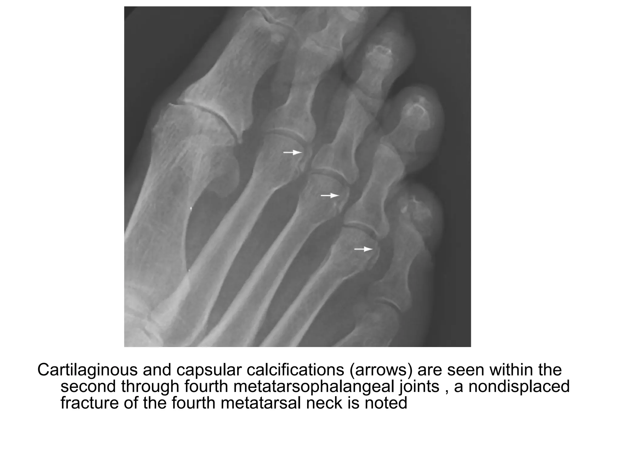 Cartilaginous and capsular calcifications (arrows) are seen within the
second through fourth metatarsophalangeal joints , a nondisplaced
fracture of the fourth metatarsal neck is noted
 