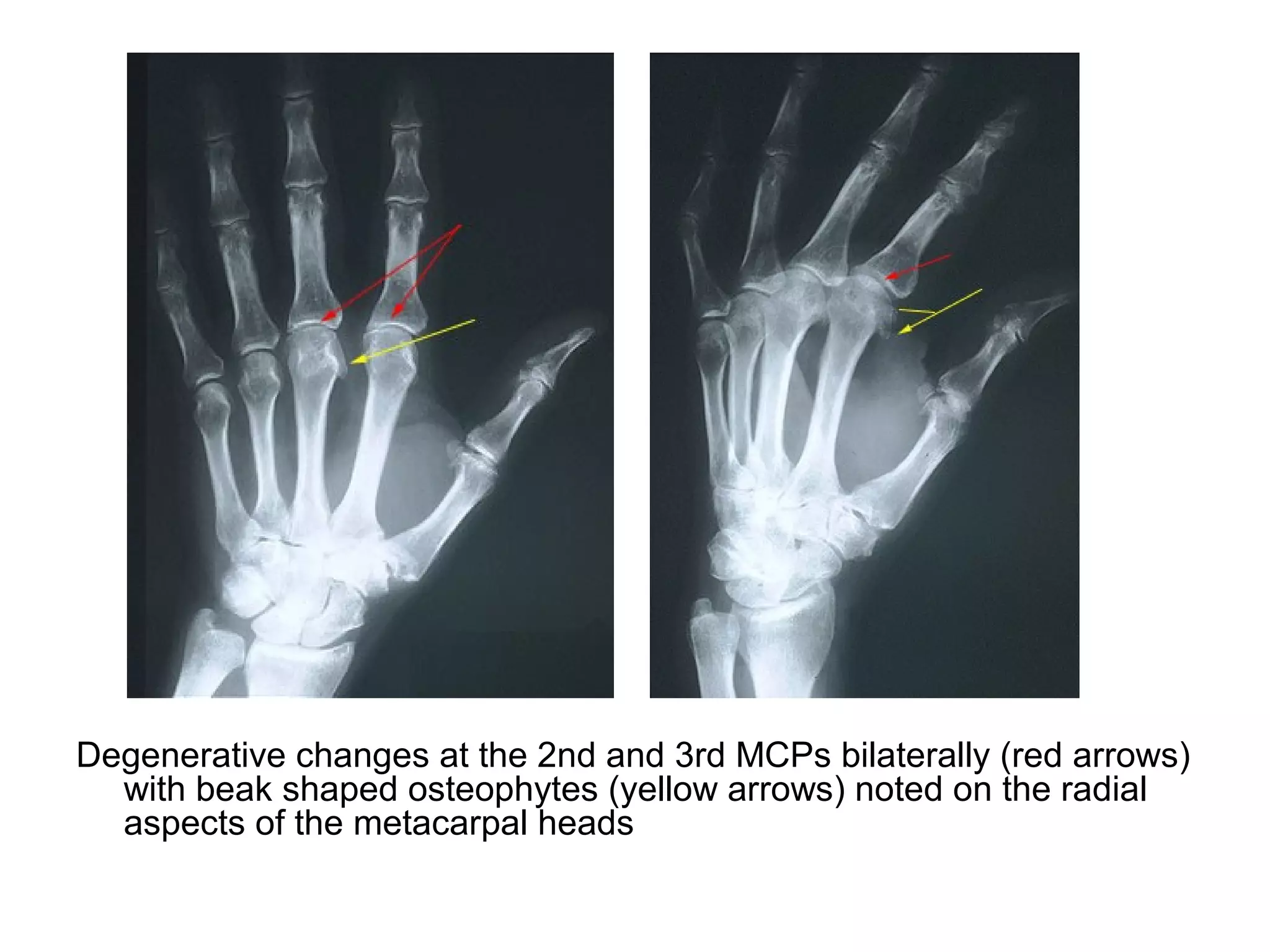 Degenerative changes at the 2nd and 3rd MCPs bilaterally (red arrows)
with beak shaped osteophytes (yellow arrows) noted on the radial
aspects of the metacarpal heads
 