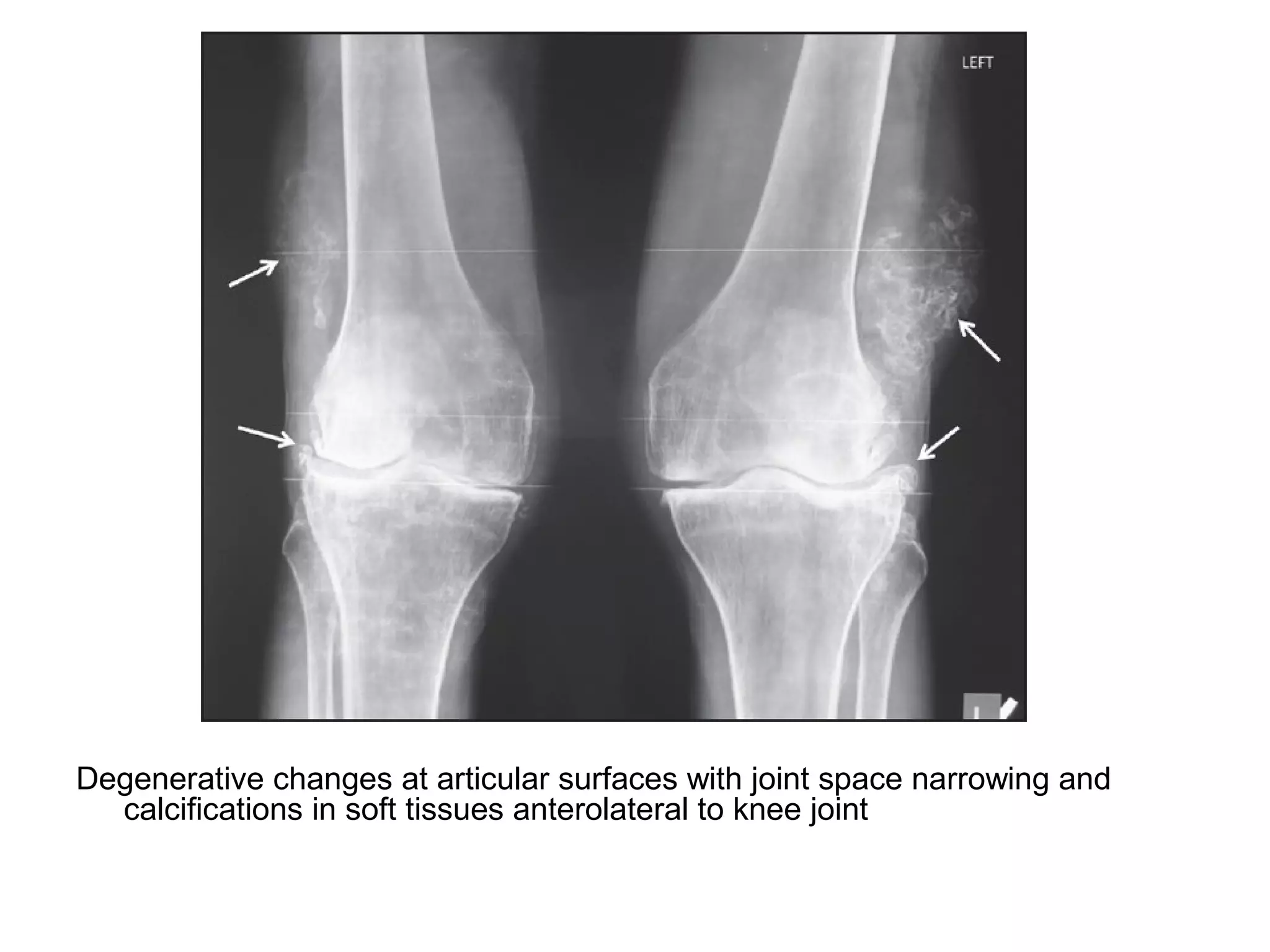 Degenerative changes at articular surfaces with joint space narrowing and
calcifications in soft tissues anterolateral to knee joint
 