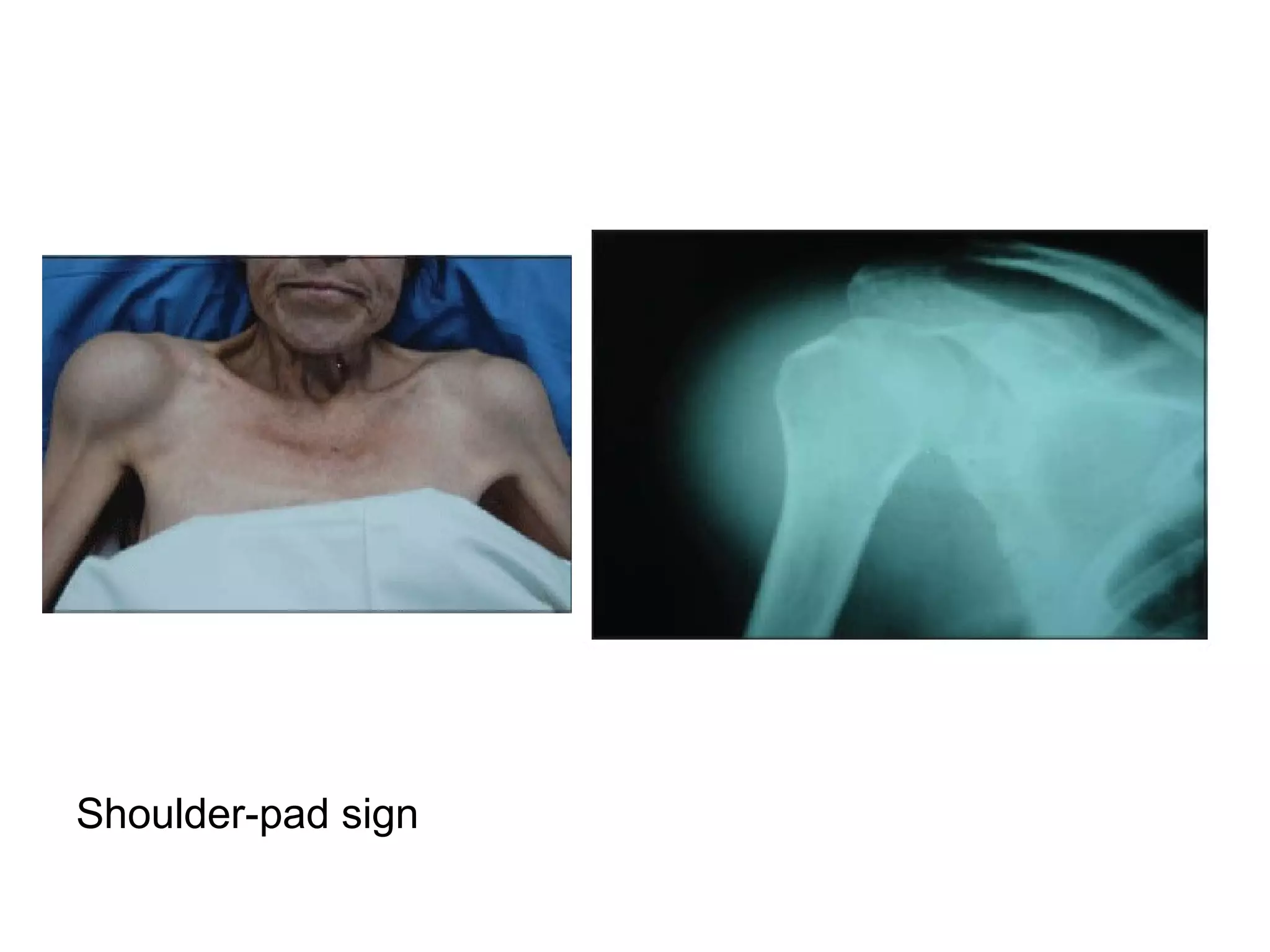 Shoulder-pad sign
 