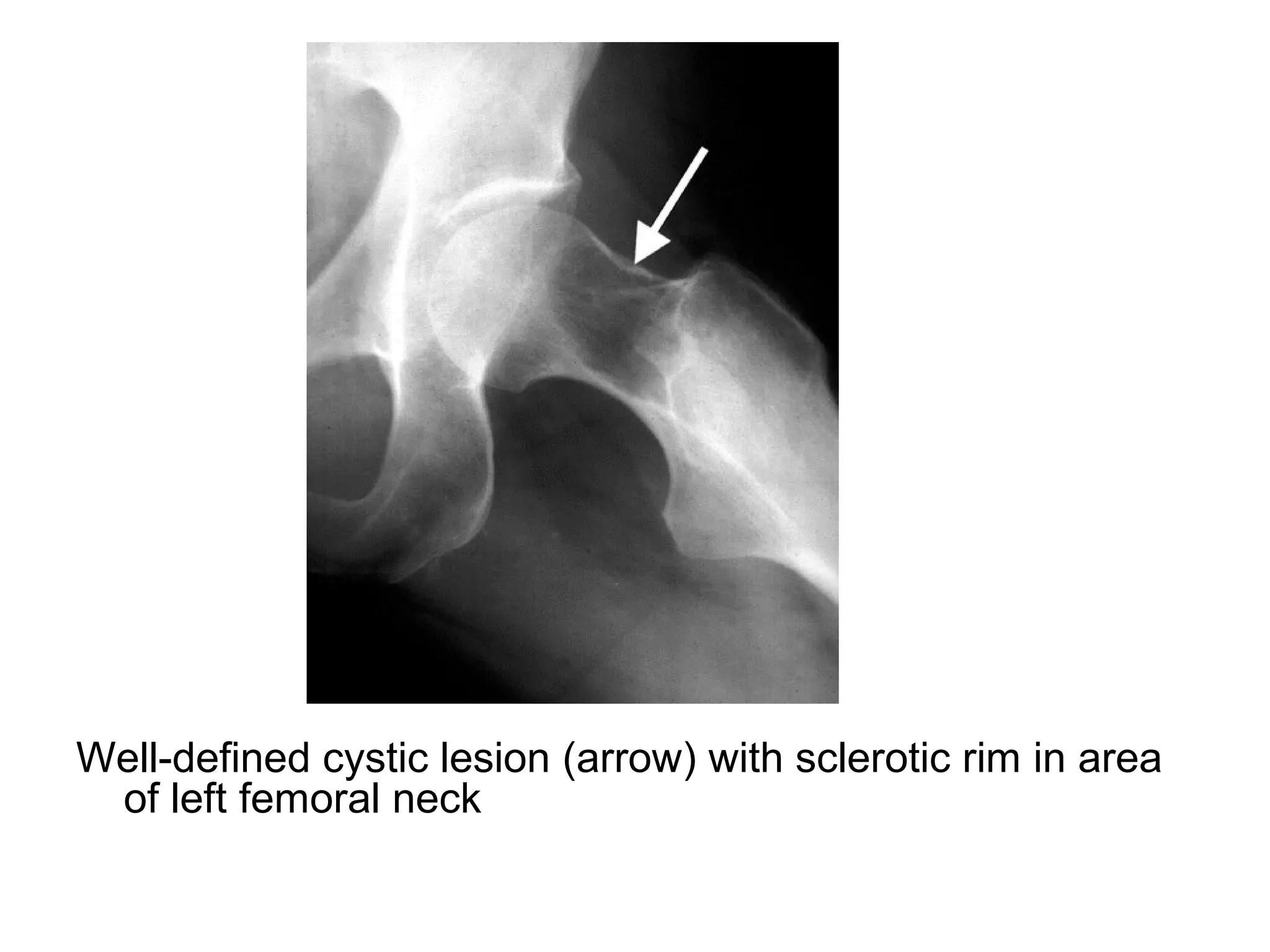 Well-defined cystic lesion (arrow) with sclerotic rim in area
of left femoral neck
 