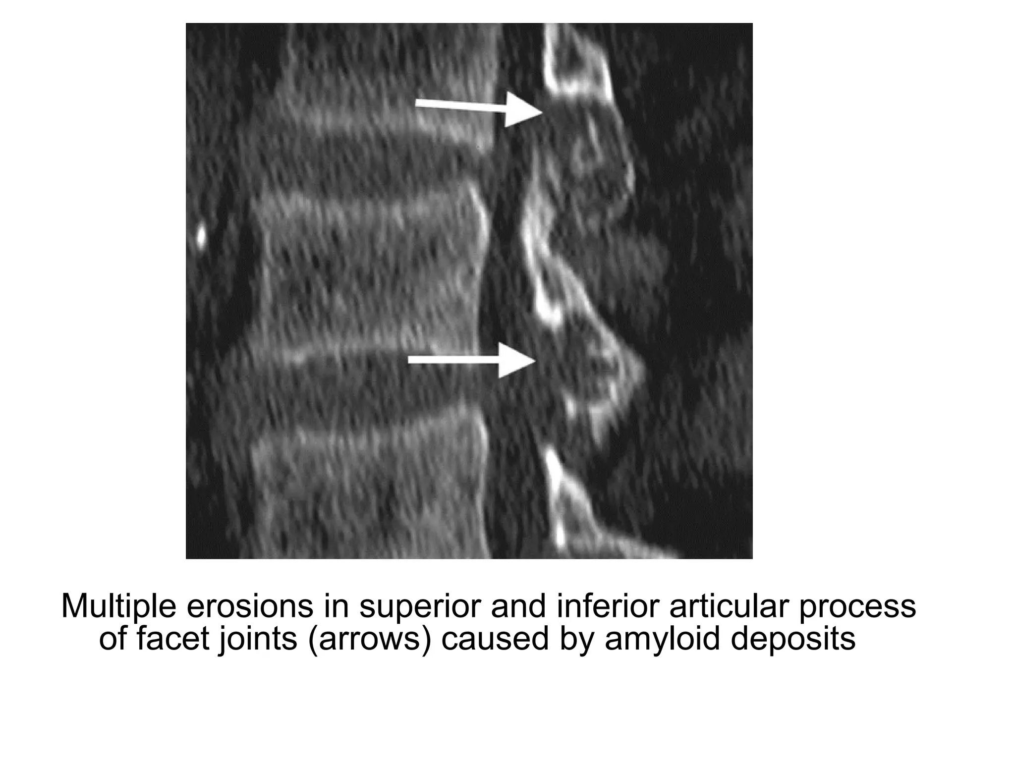 Multiple erosions in superior and inferior articular process
of facet joints (arrows) caused by amyloid deposits
 