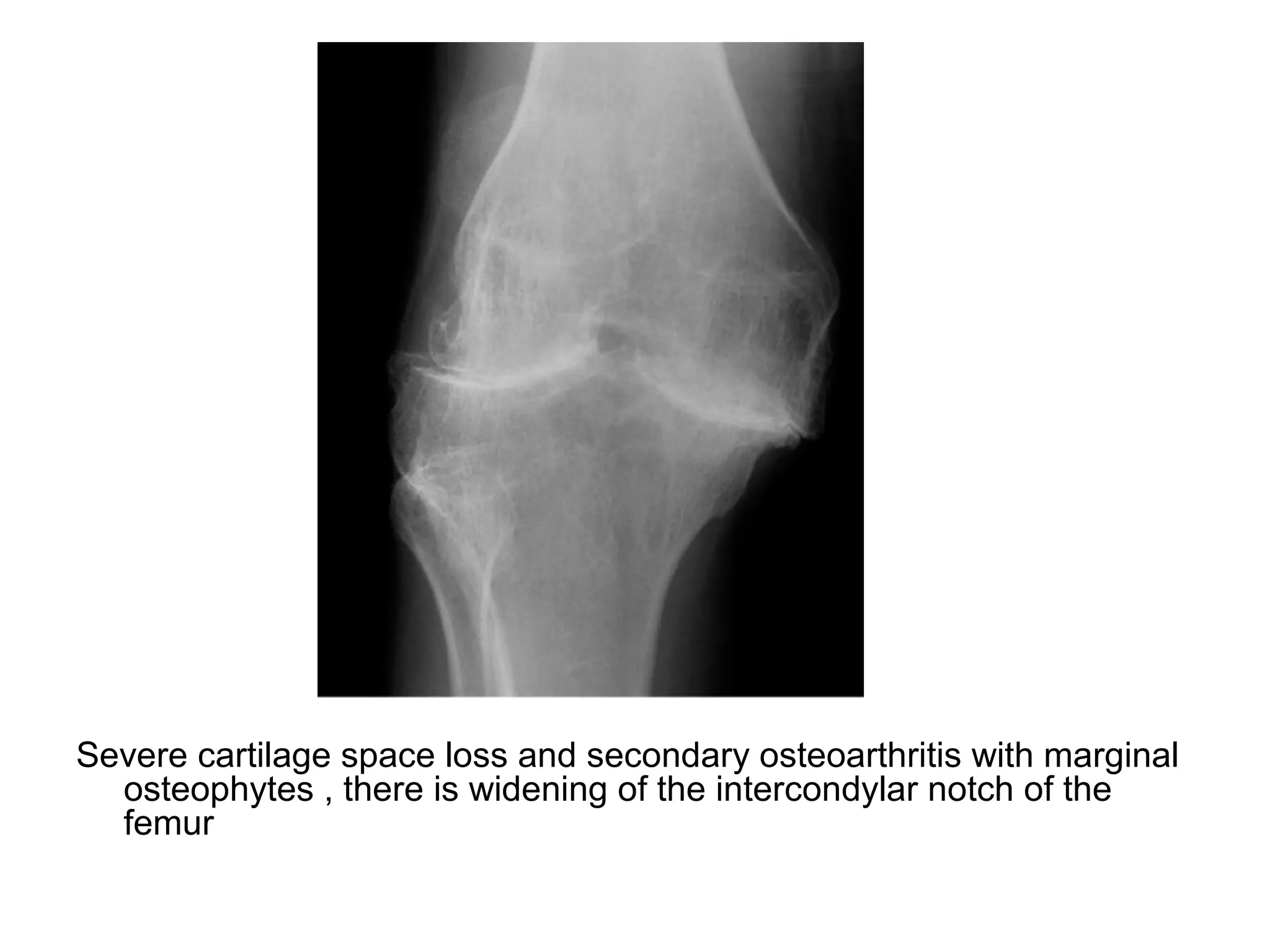 Severe cartilage space loss and secondary osteoarthritis with marginal
osteophytes , there is widening of the intercondylar notch of the
femur
 