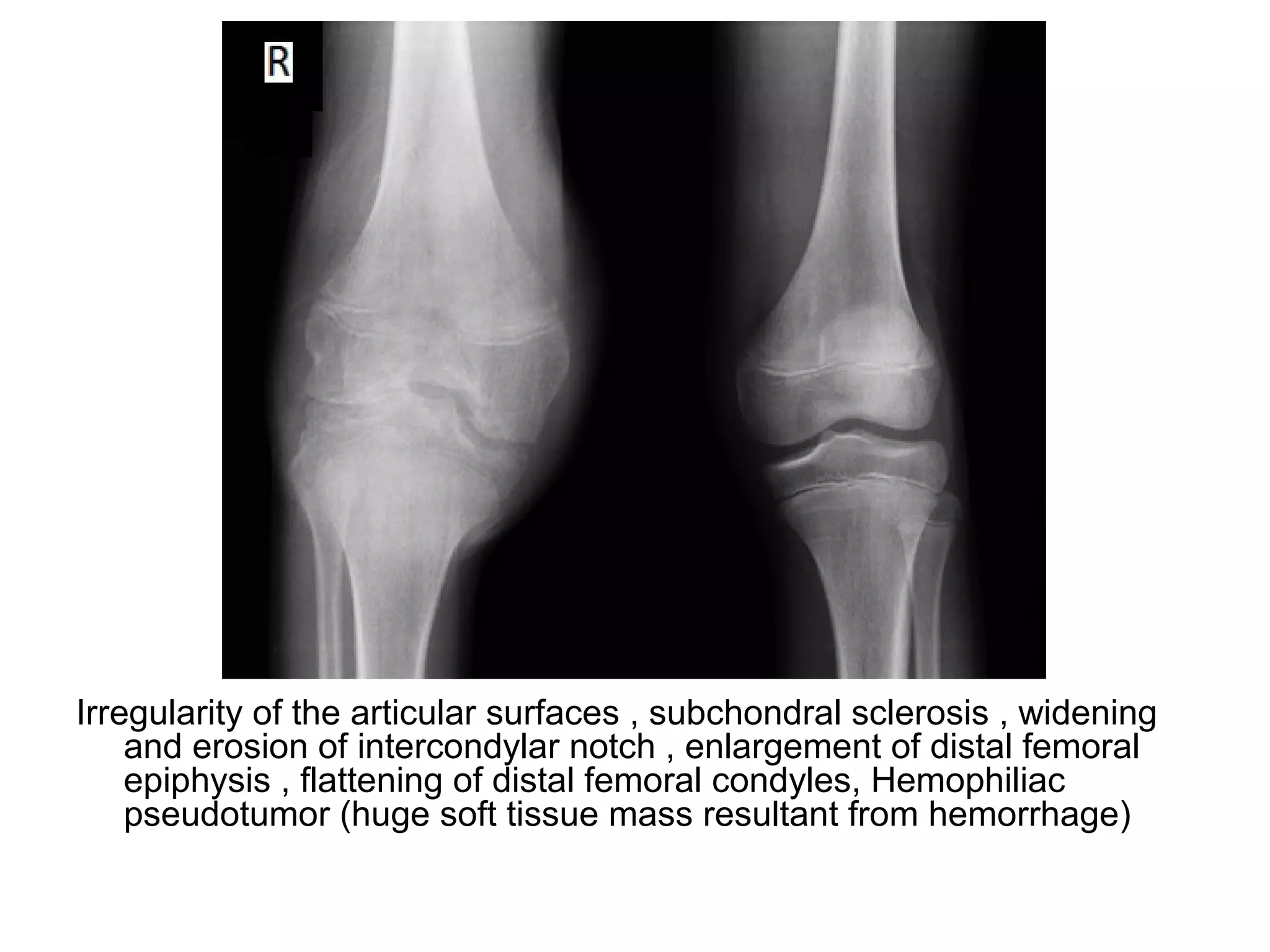 Irregularity of the articular surfaces , subchondral sclerosis , widening
and erosion of intercondylar notch , enlargement of distal femoral
epiphysis , flattening of distal femoral condyles, Hemophiliac
pseudotumor (huge soft tissue mass resultant from hemorrhage)
 
