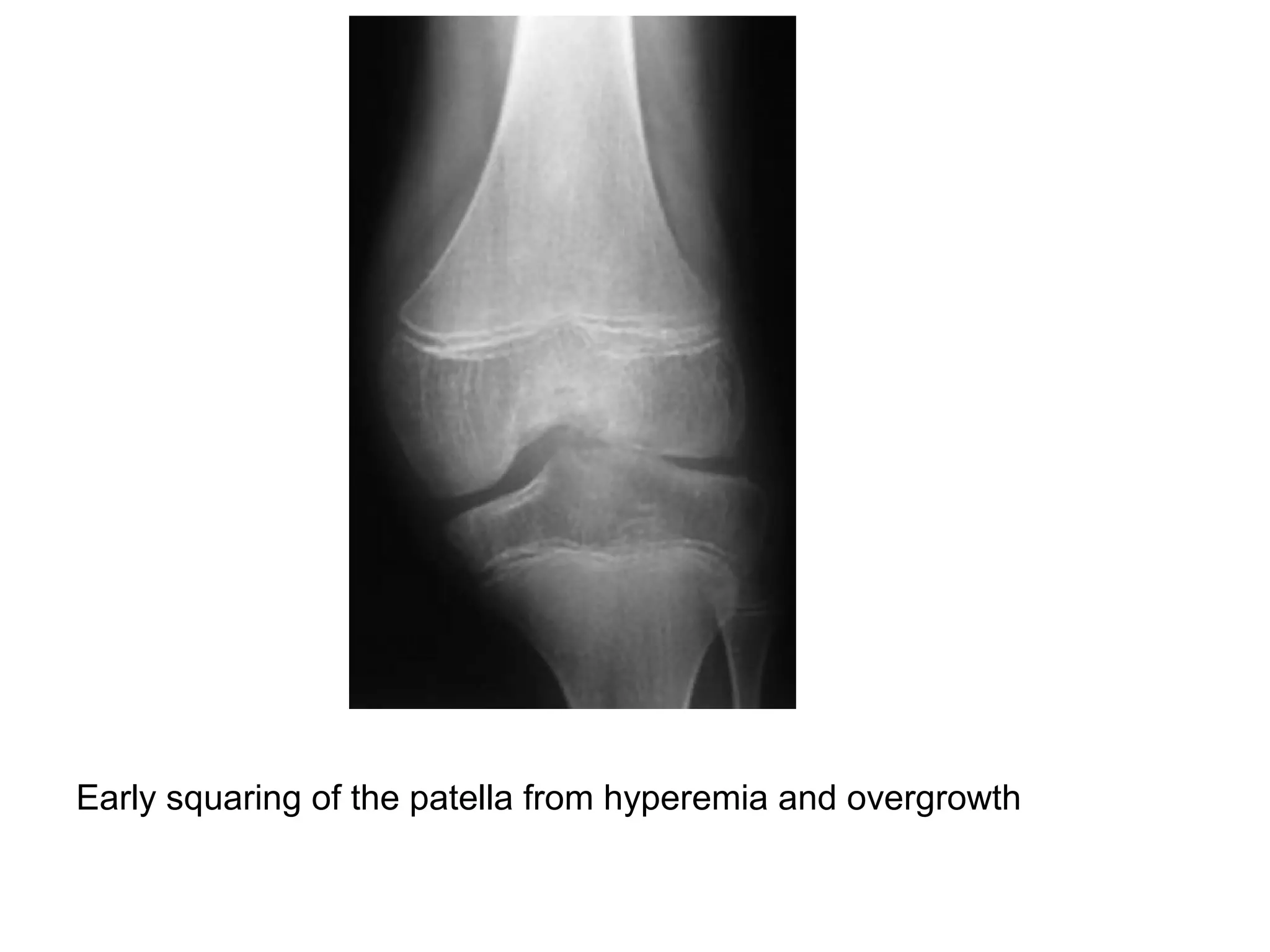 Early squaring of the patella from hyperemia and overgrowth
 