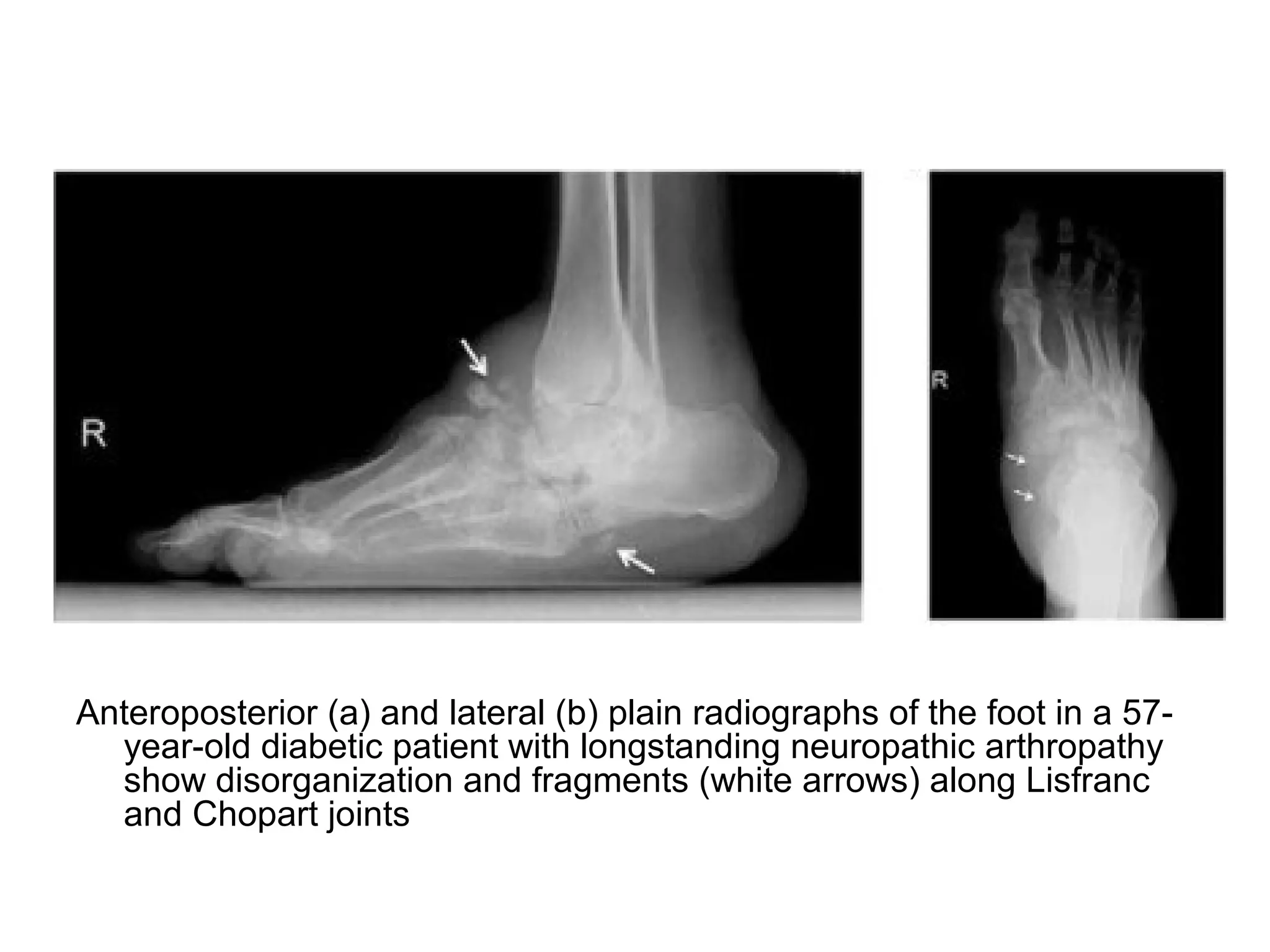 Anteroposterior (a) and lateral (b) plain radiographs of the foot in a 57-
year-old diabetic patient with longstanding neuropathic arthropathy
show disorganization and fragments (white arrows) along Lisfranc
and Chopart joints
 
