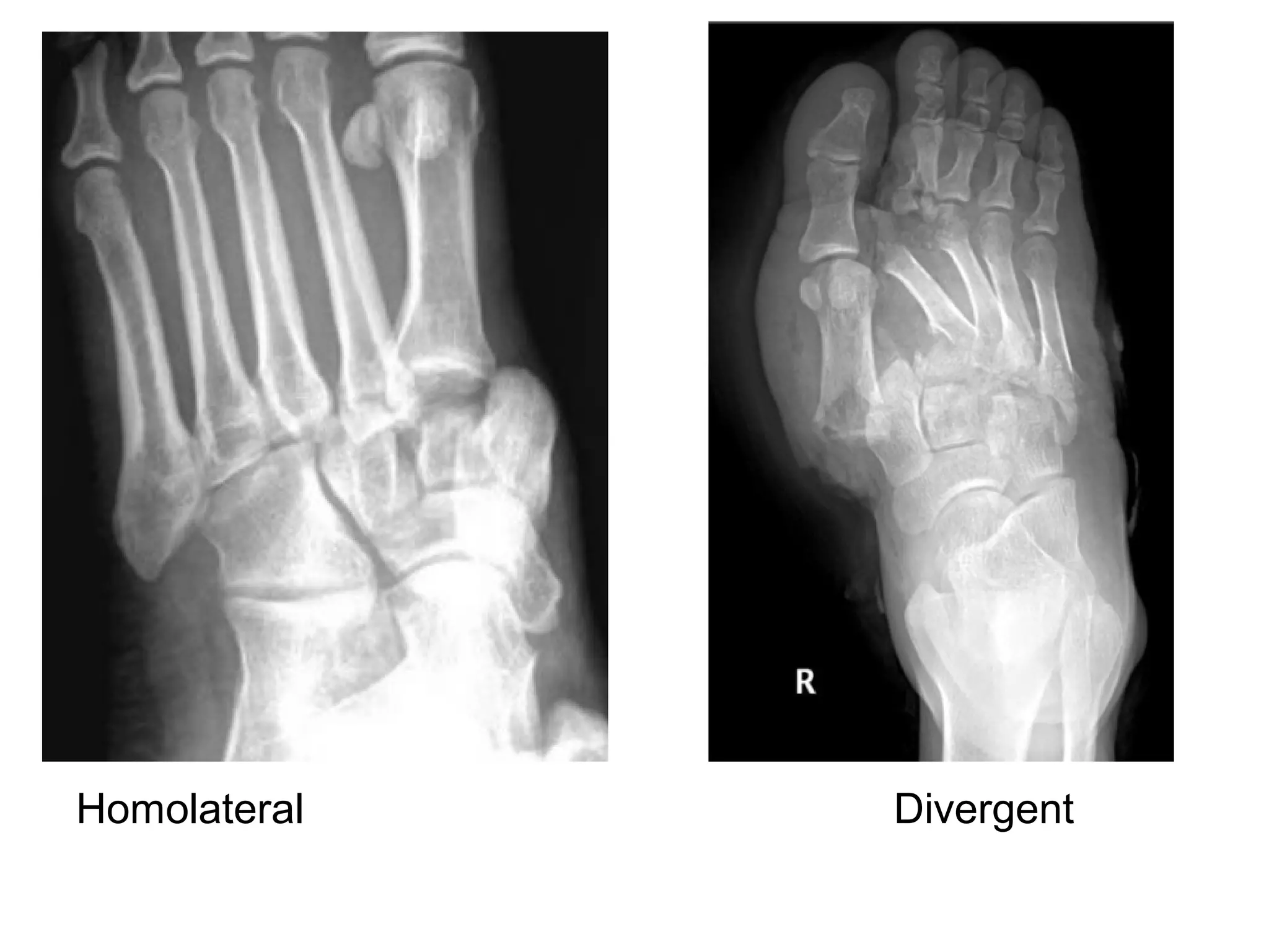 Homolateral Divergent
 
