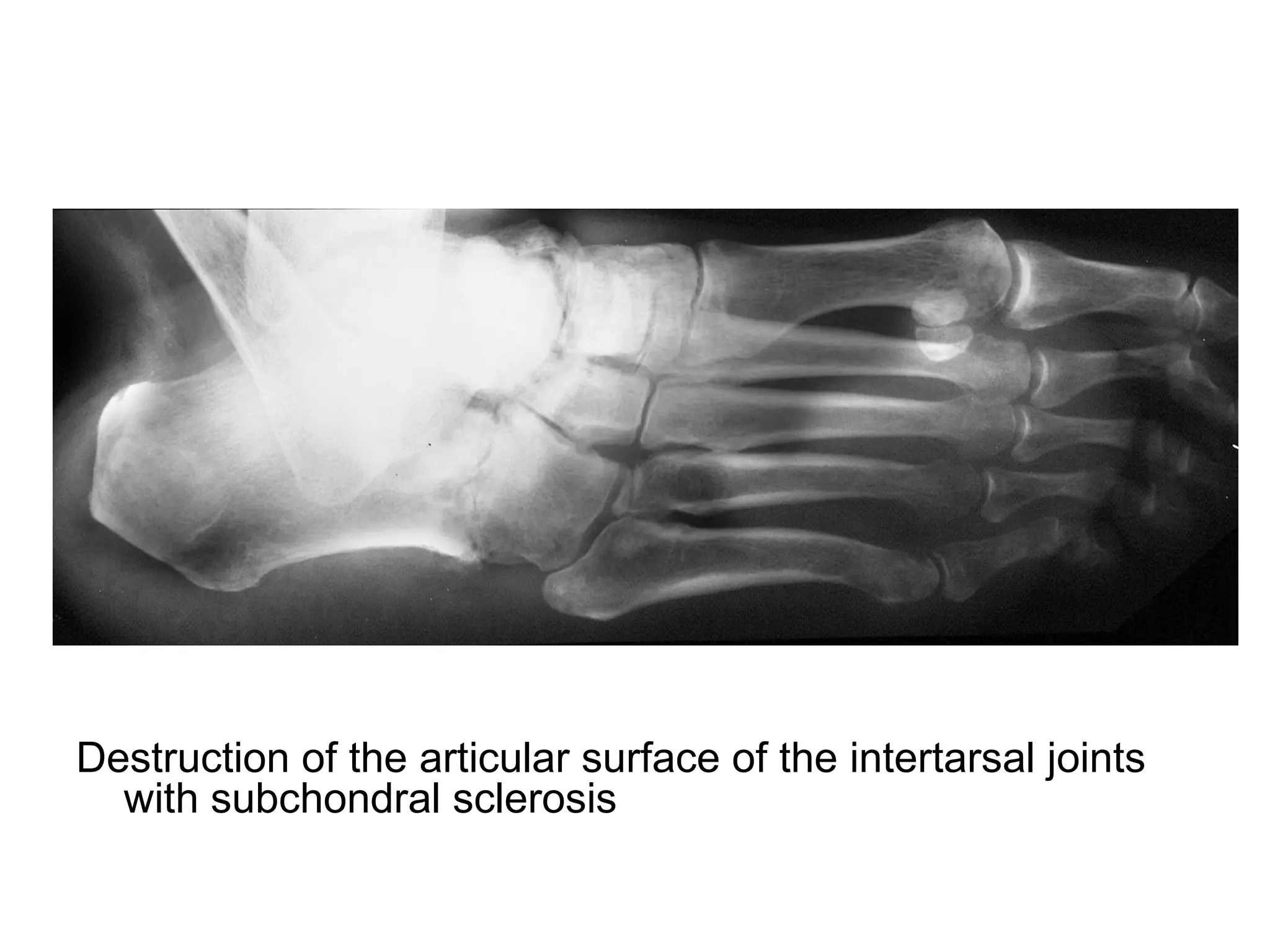 Destruction of the articular surface of the intertarsal joints
with subchondral sclerosis
 