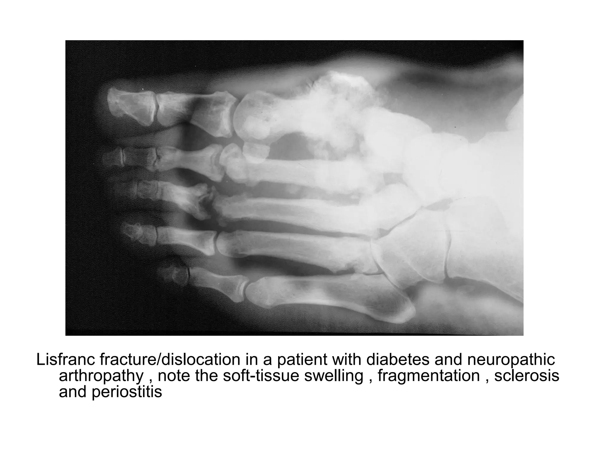 Lisfranc fracture/dislocation in a patient with diabetes and neuropathic
arthropathy , note the soft-tissue swelling , fragmentation , sclerosis
and periostitis
 