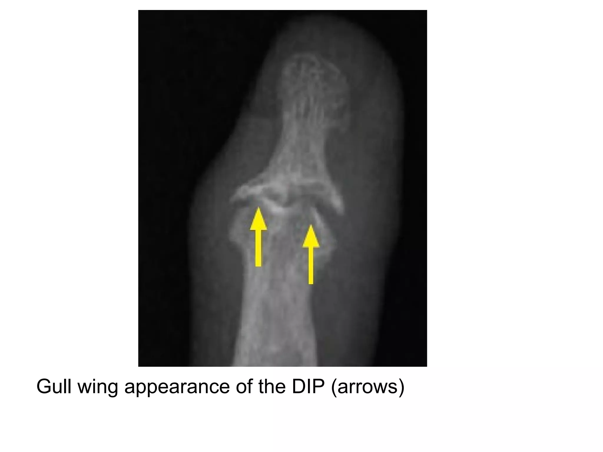Gull wing appearance of the DIP (arrows)
 