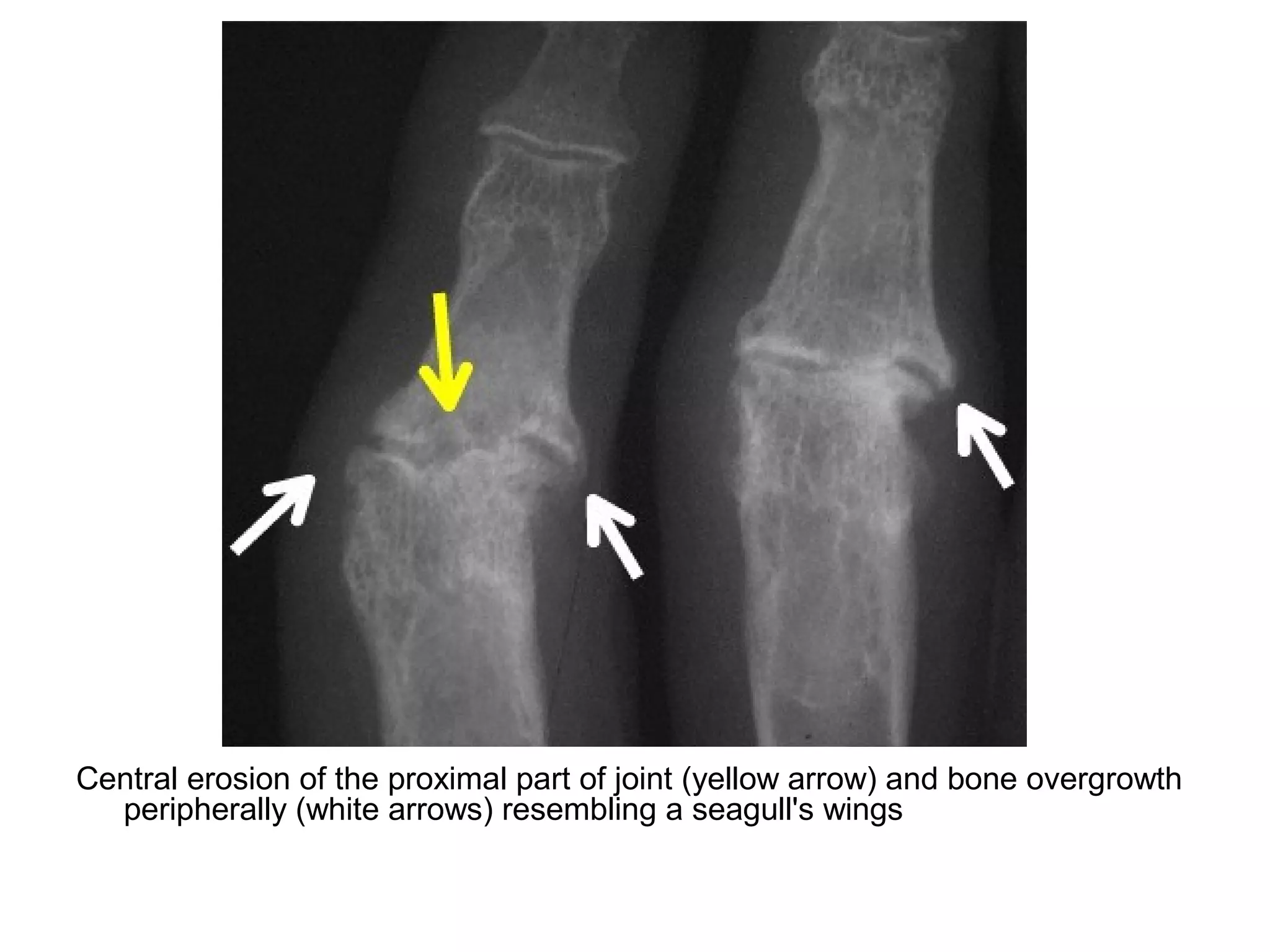 Central erosion of the proximal part of joint (yellow arrow) and bone overgrowth
peripherally (white arrows) resembling a seagull's wings
 