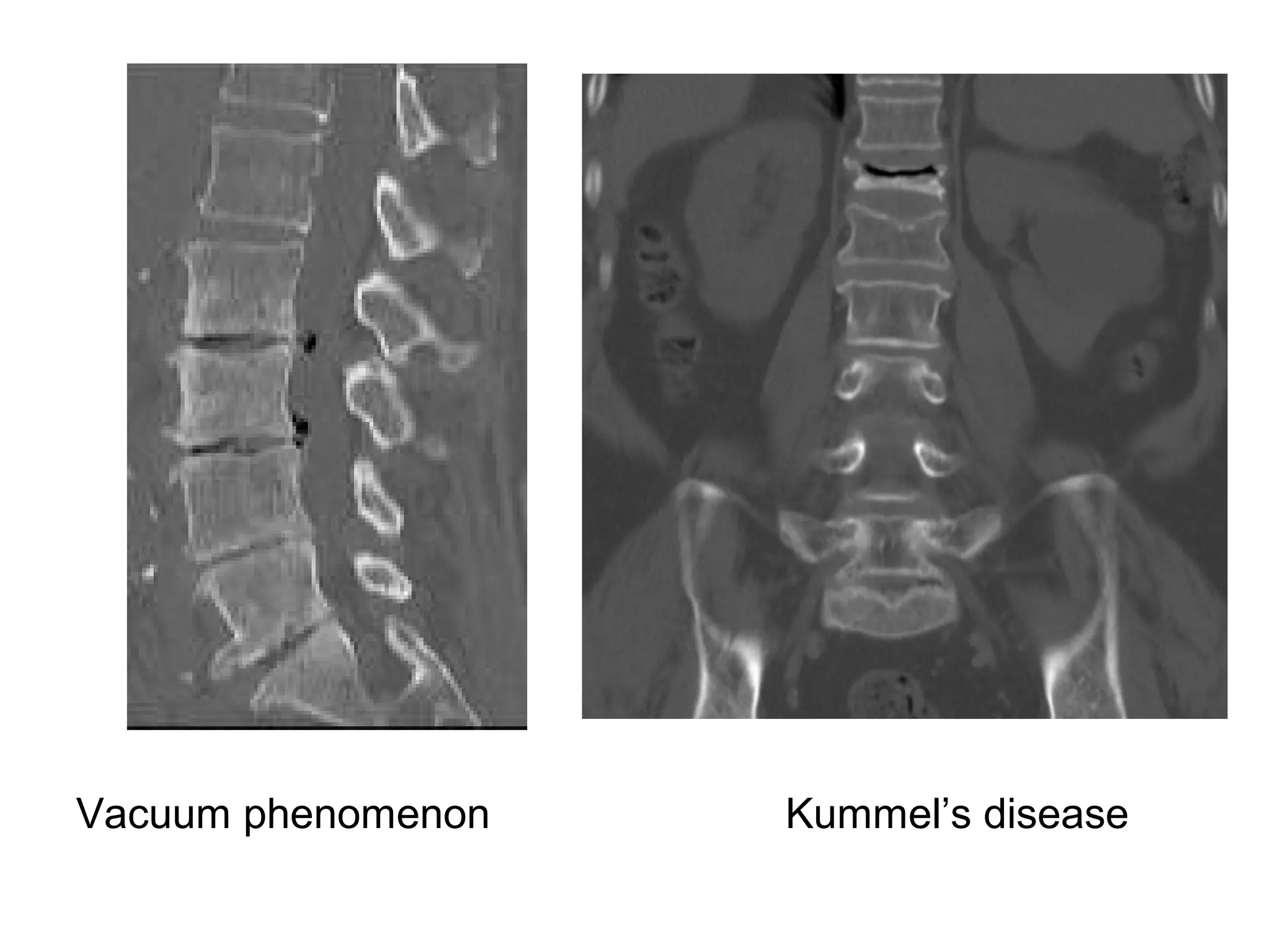Vacuum phenomenon Kummel’s disease
 