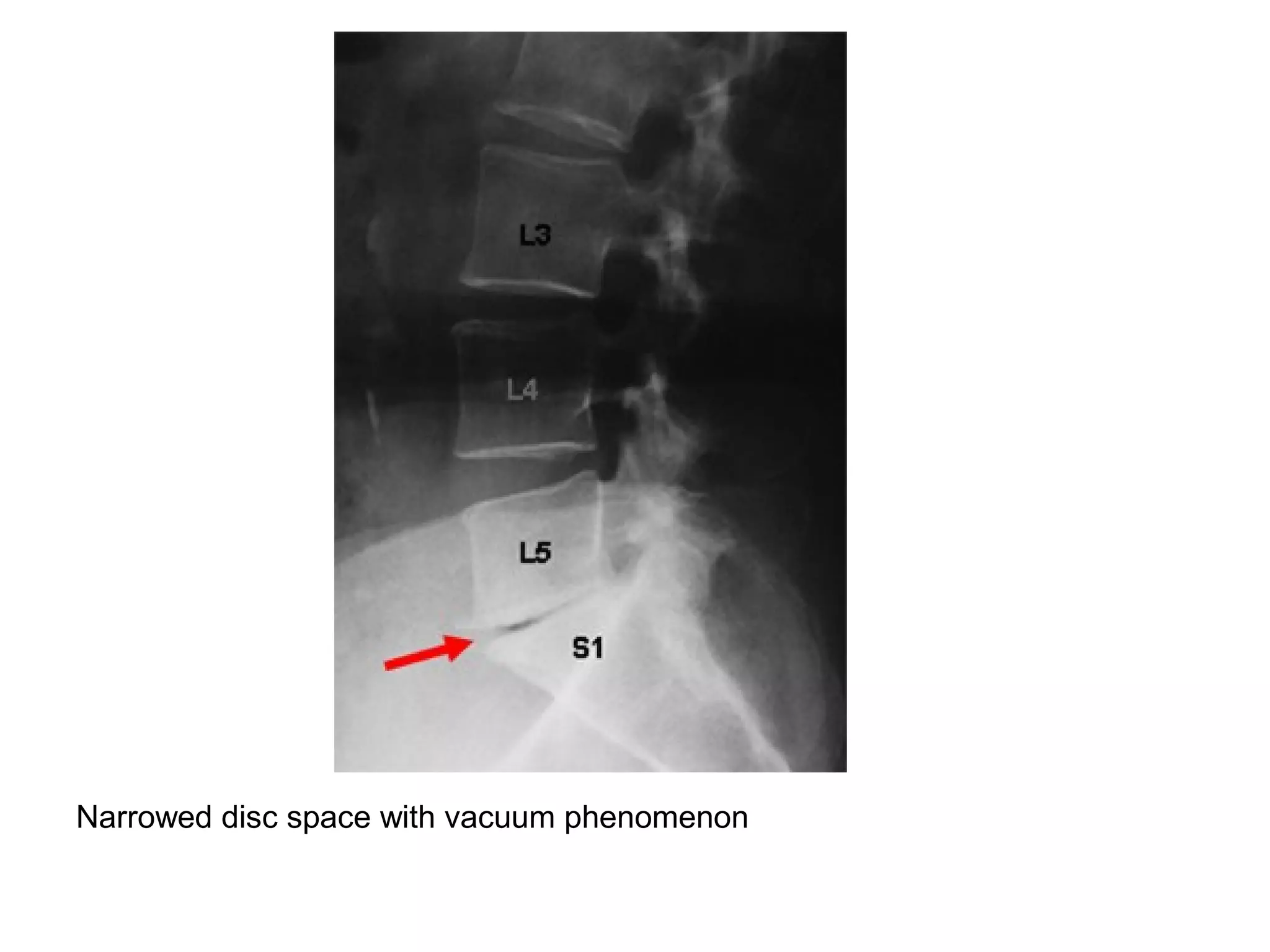 Narrowed disc space with vacuum phenomenon
 