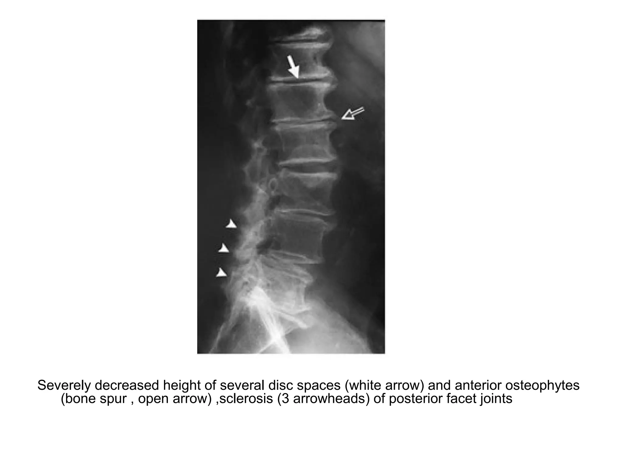 Severely decreased height of several disc spaces (white arrow) and anterior osteophytes
(bone spur , open arrow) ,sclerosis (3 arrowheads) of posterior facet joints
 