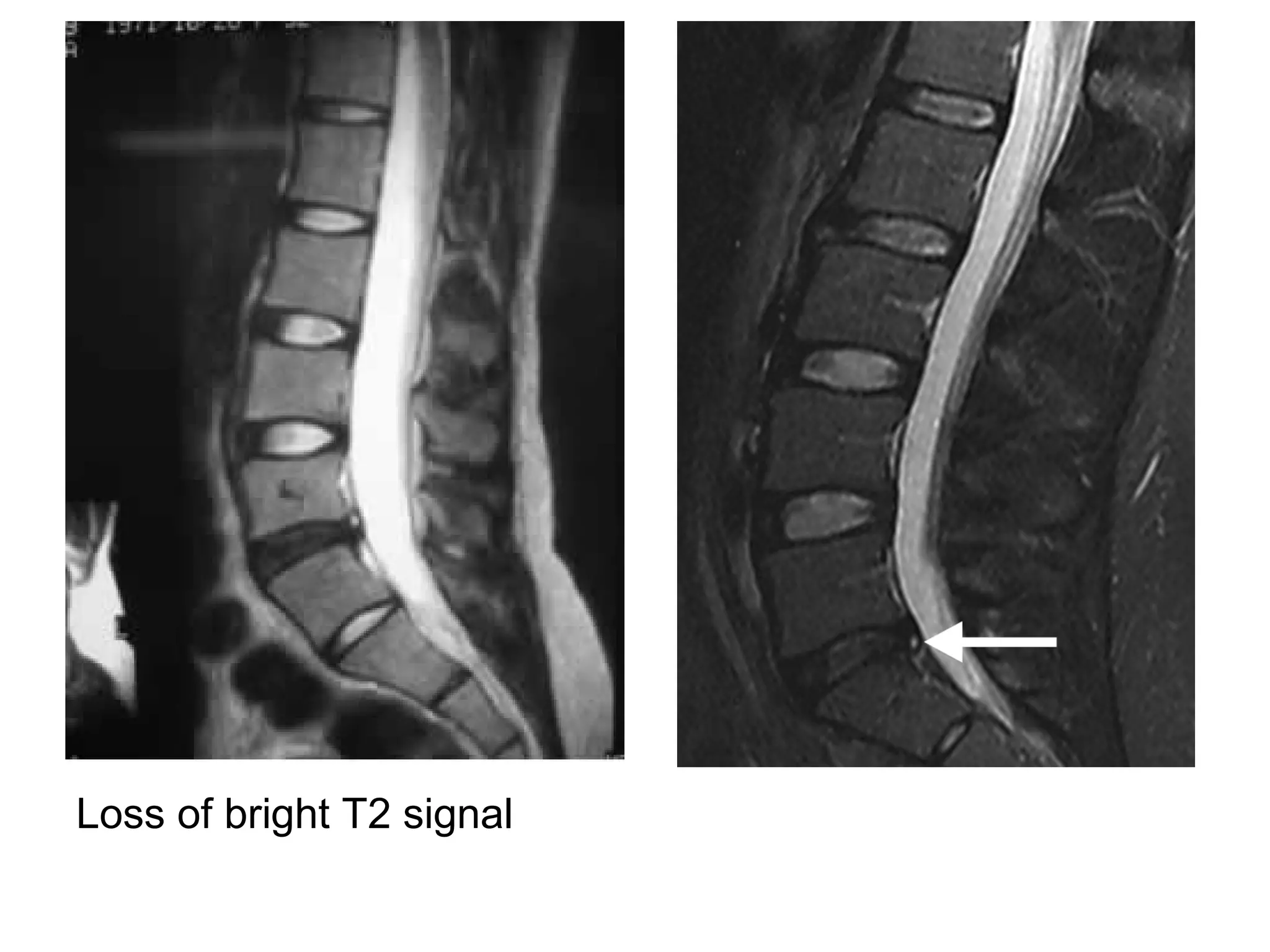 Loss of bright T2 signal
 