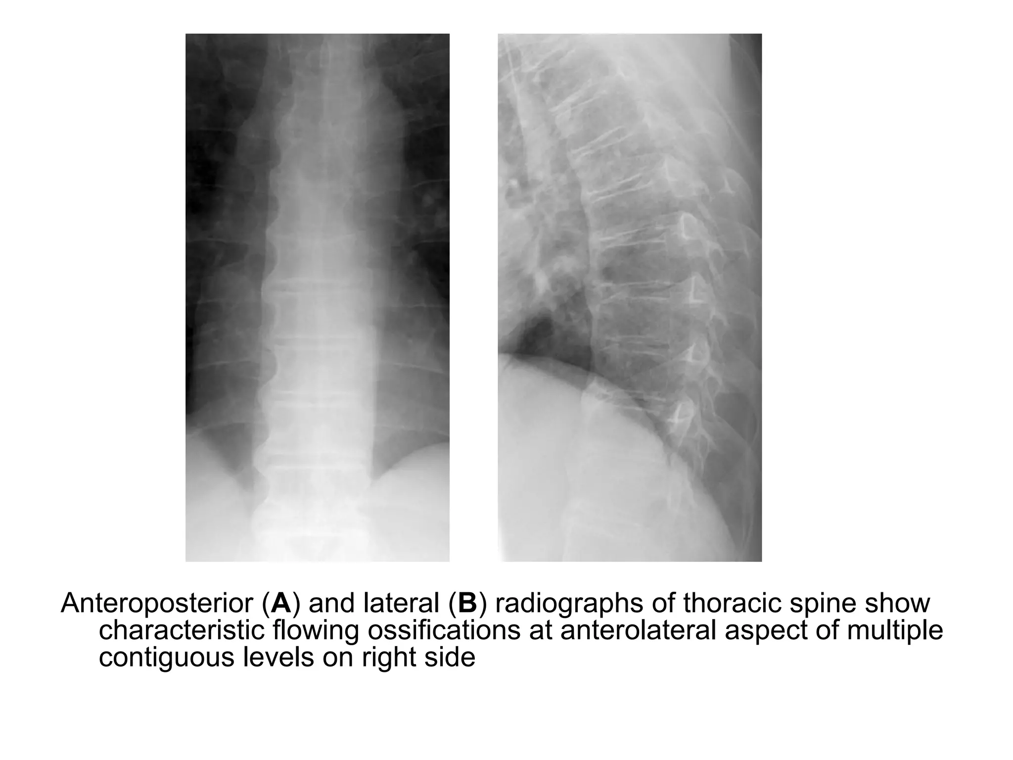 Anteroposterior (A) and lateral (B) radiographs of thoracic spine show
characteristic flowing ossifications at anterolateral aspect of multiple
contiguous levels on right side
 