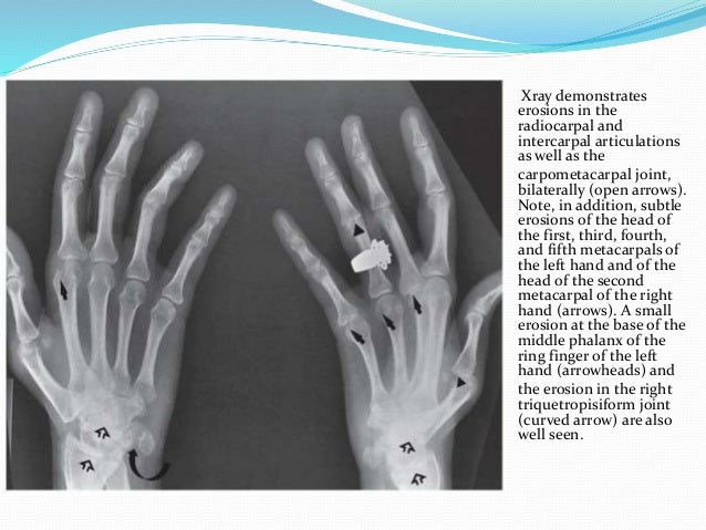 Radiological evaluation of Arthritis