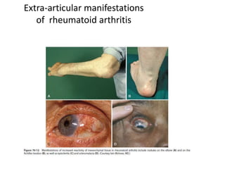 Extra-articular manifestations
of rheumatoid arthritis
 