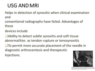 USG ANDMRI
Helps in detection of synovitis when clinical examination
and
conventional radiographs have failed. Advantages of
these
devices include
Ability to detect subtle synovitis and soft tissue
abnormalities as tendon rupture or tenosynovitis
To permit more accurate placement of the needle in
diagnostic arthrocentesis and therapeutic
Injections.
 