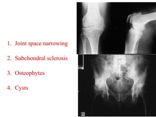 X-ray changes
1. Joint space narrowing
2. Subchondral sclerosis
3. Osteophytes
4. Cysts
 