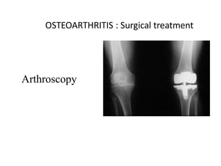 OSTEOARTHRITIS : Surgical treatment
Arthroscopy Osteotomy
Arthrodesis Excision
arthroplasty
Replacement arthroplasty
 